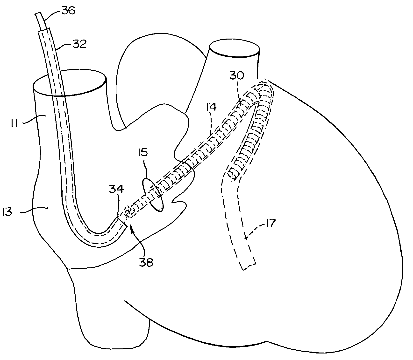 Device implantable in the coronary sinus to provide mitral valve therapy