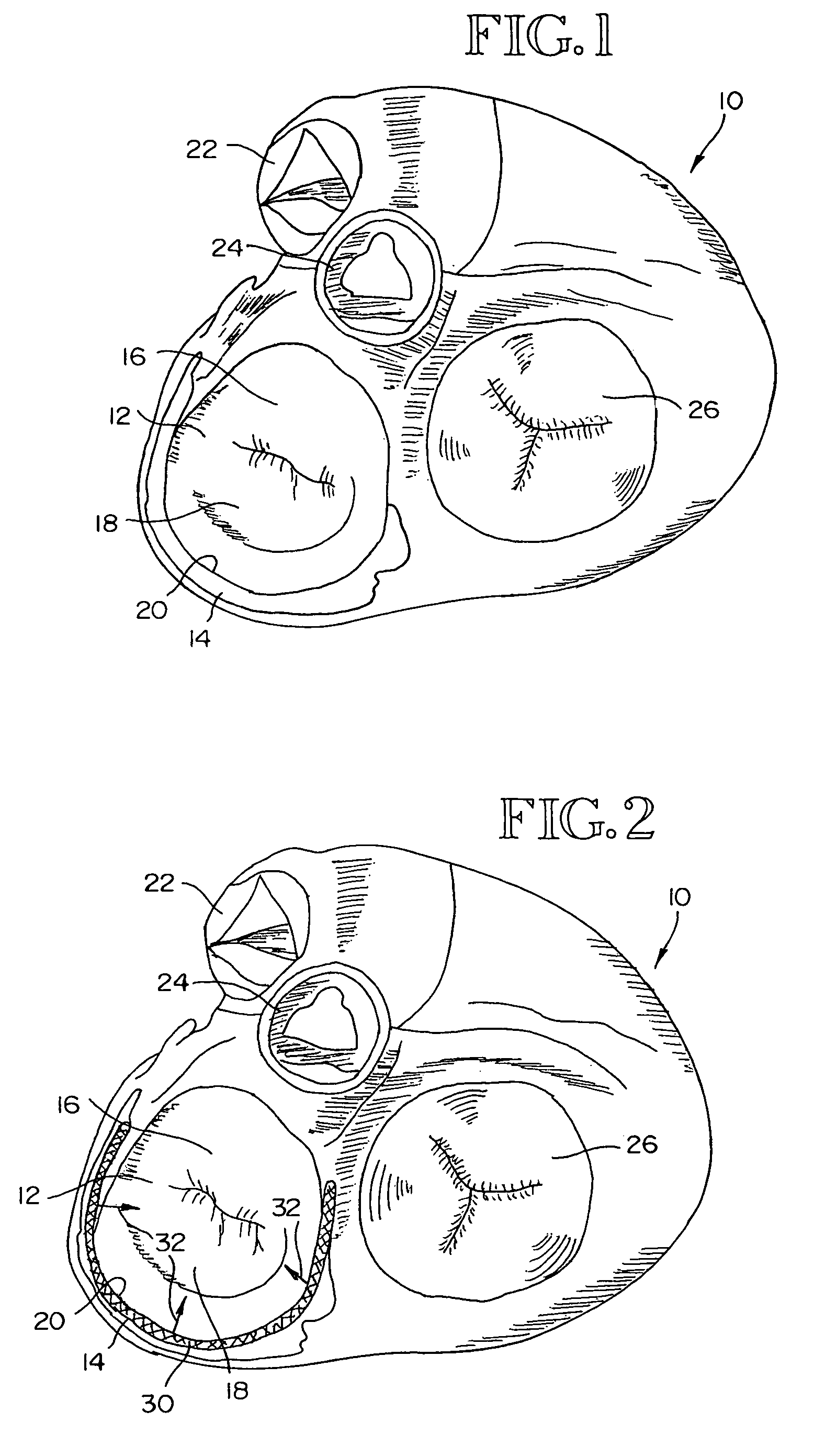 Device implantable in the coronary sinus to provide mitral valve therapy