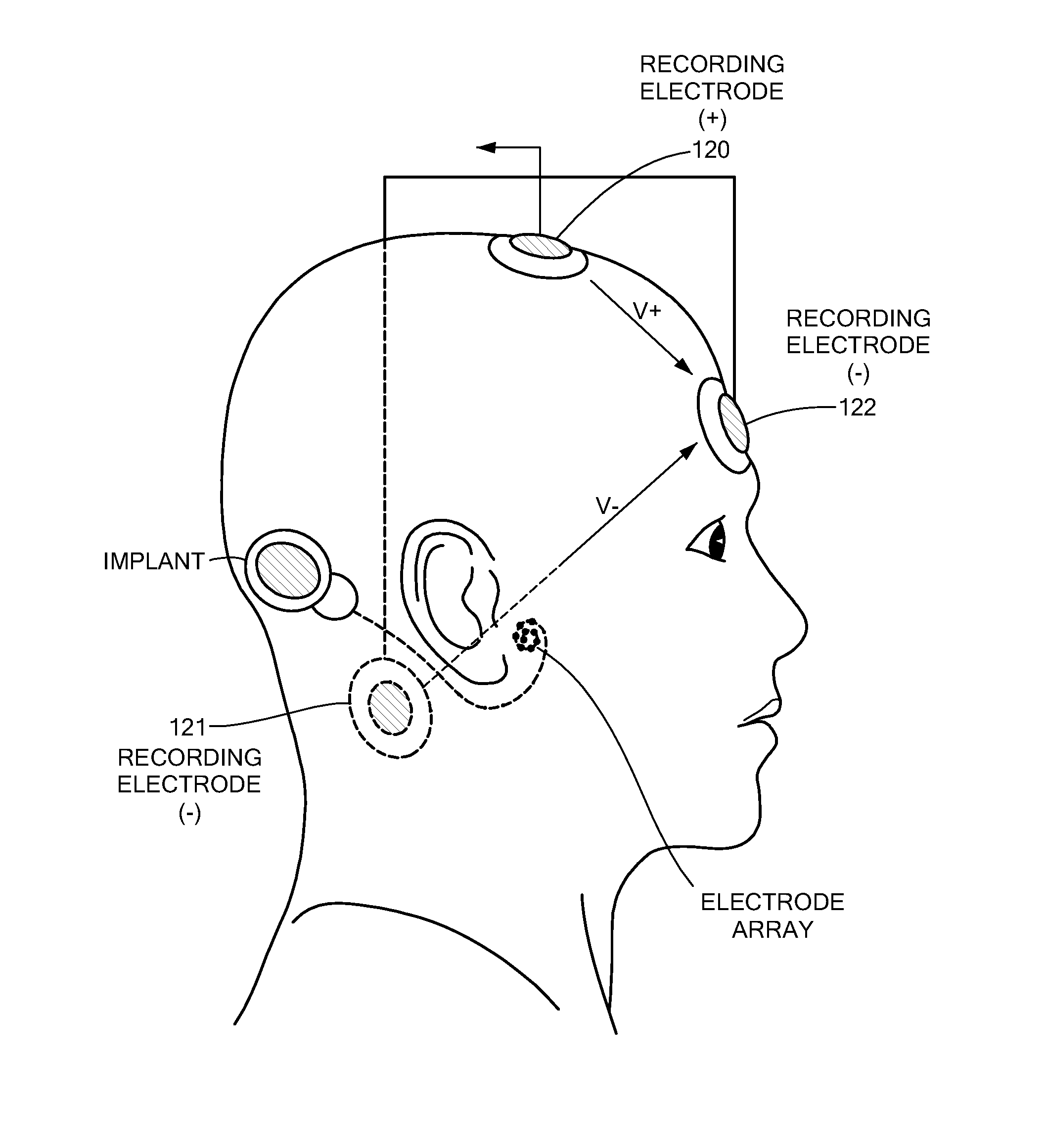 Electrically evoked brainstem response measurements via implant prothesis