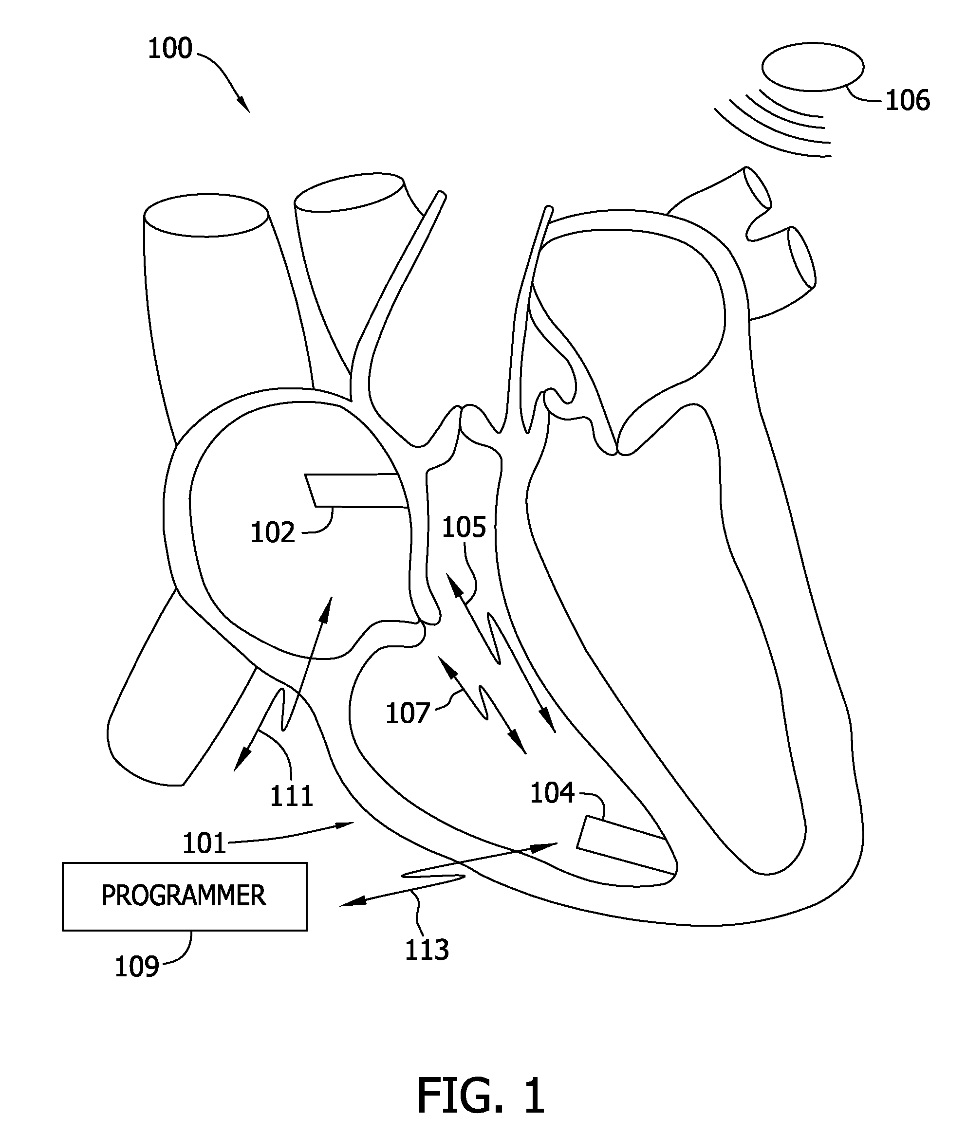 Dual chamber leadless pacemaker programmer and method