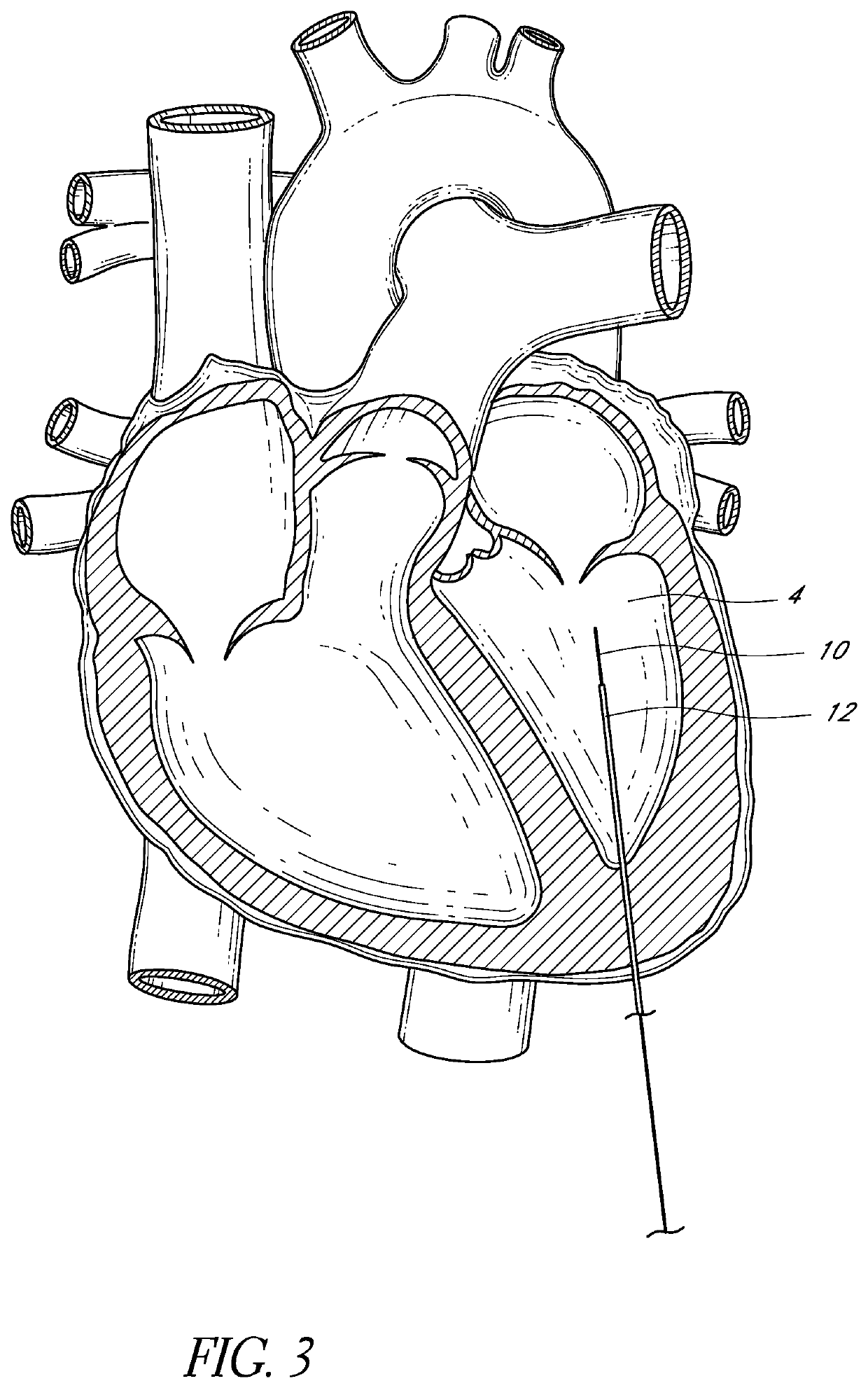 Cardiovascular access and device delivery system