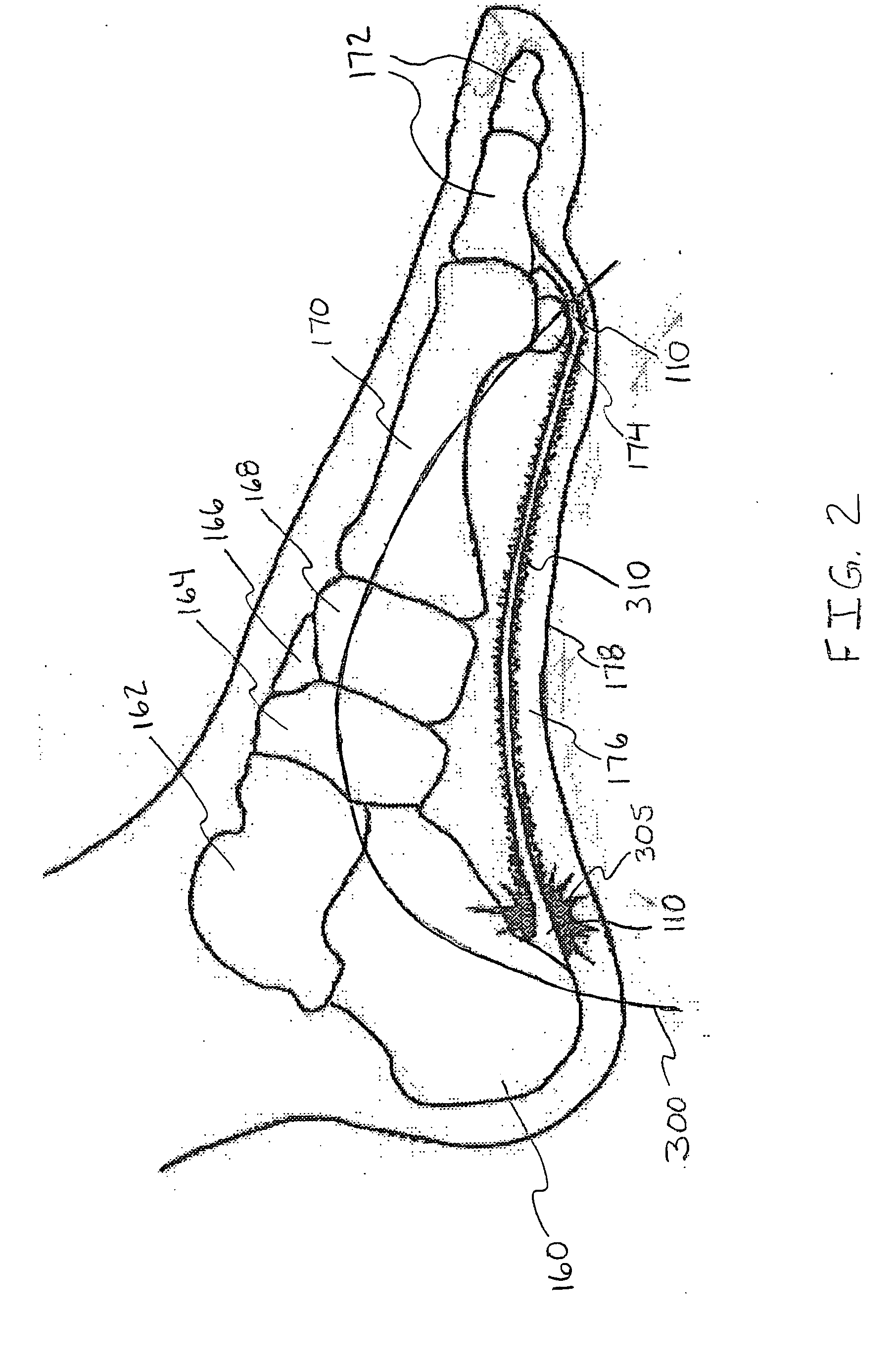 System for treatment of plantar fasciitis