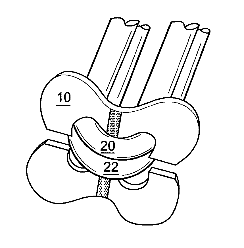 Acromioclavicular joint fixation using suture button contstruct with dog bone-shaped button