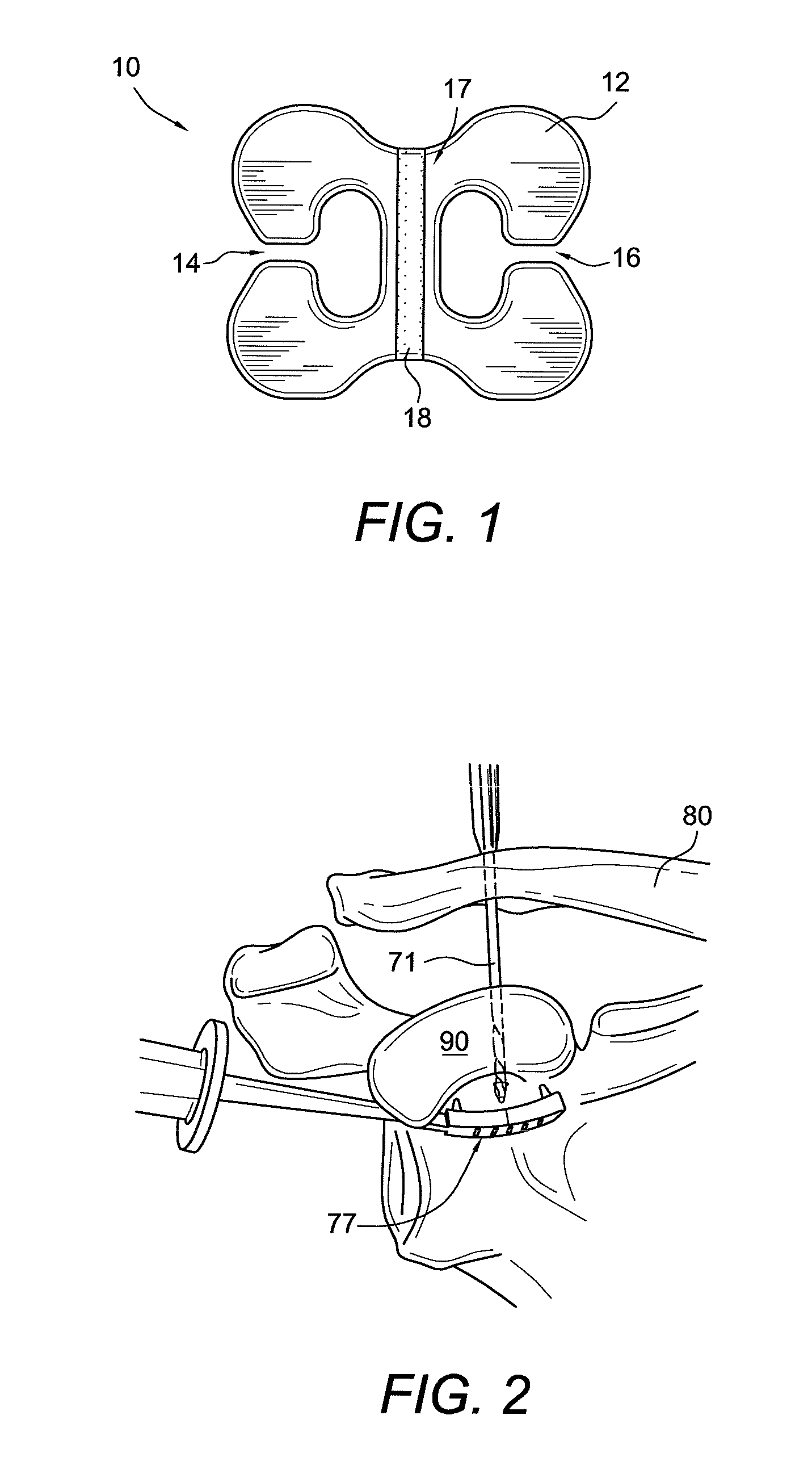 Acromioclavicular joint fixation using suture button contstruct with dog bone-shaped button