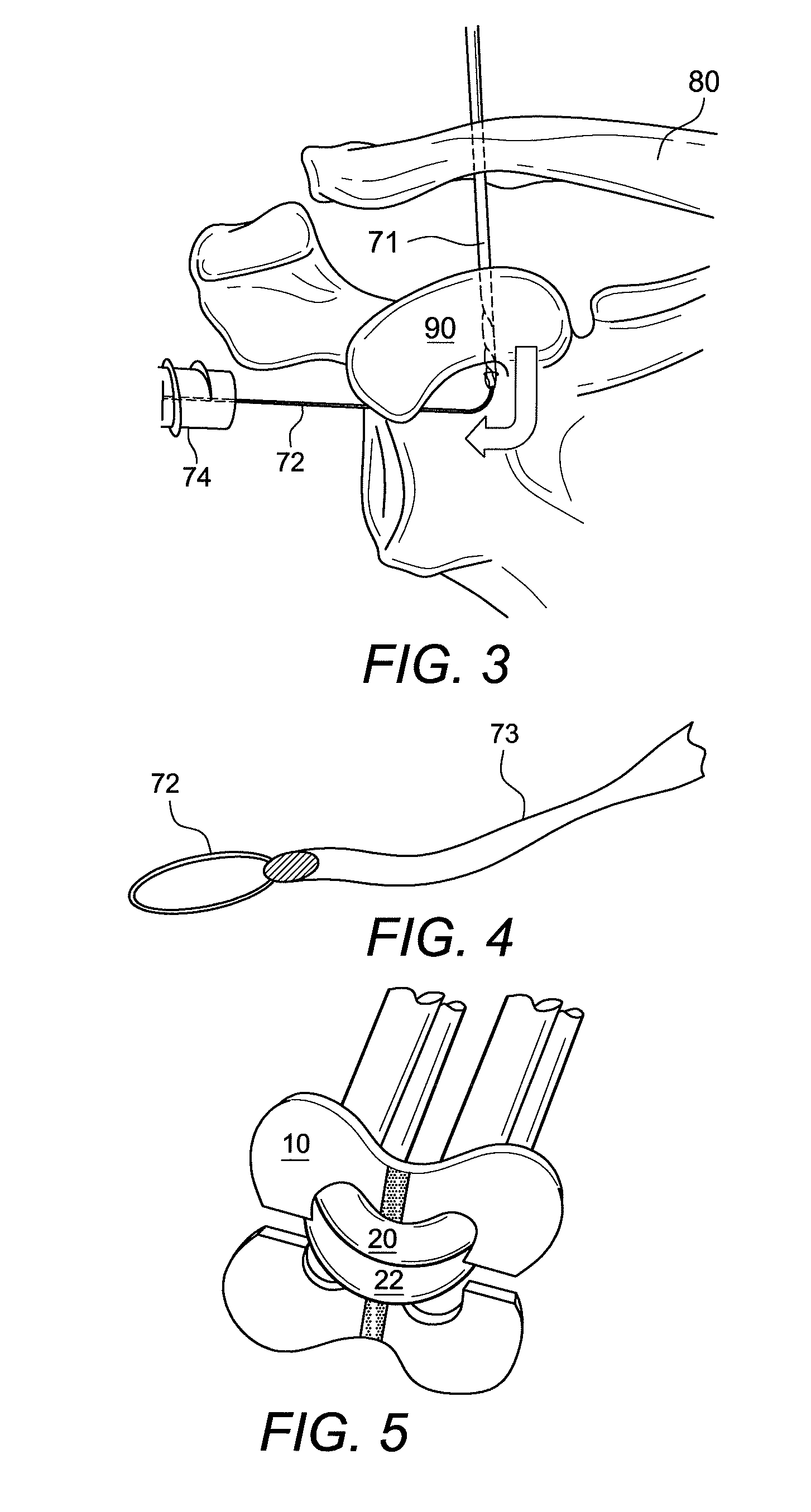 Acromioclavicular joint fixation using suture button contstruct with dog bone-shaped button