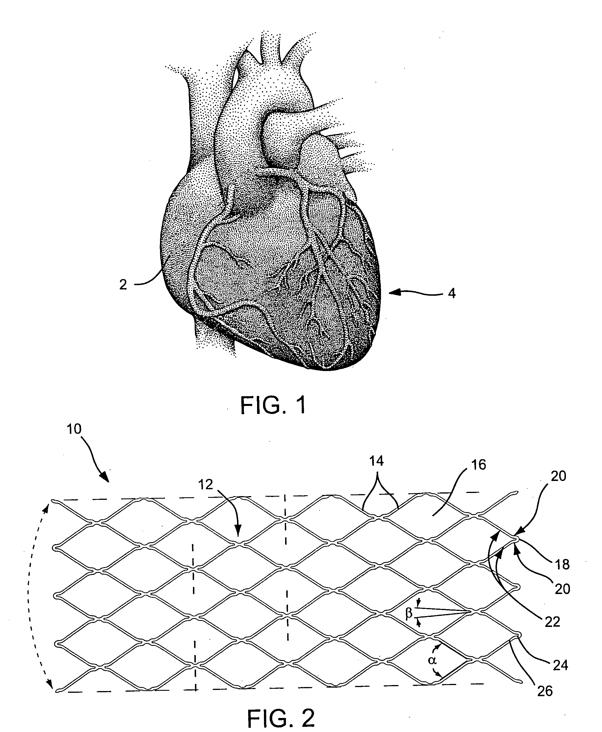 Corewire actuated delivery system with fixed distal stent-carrying extension