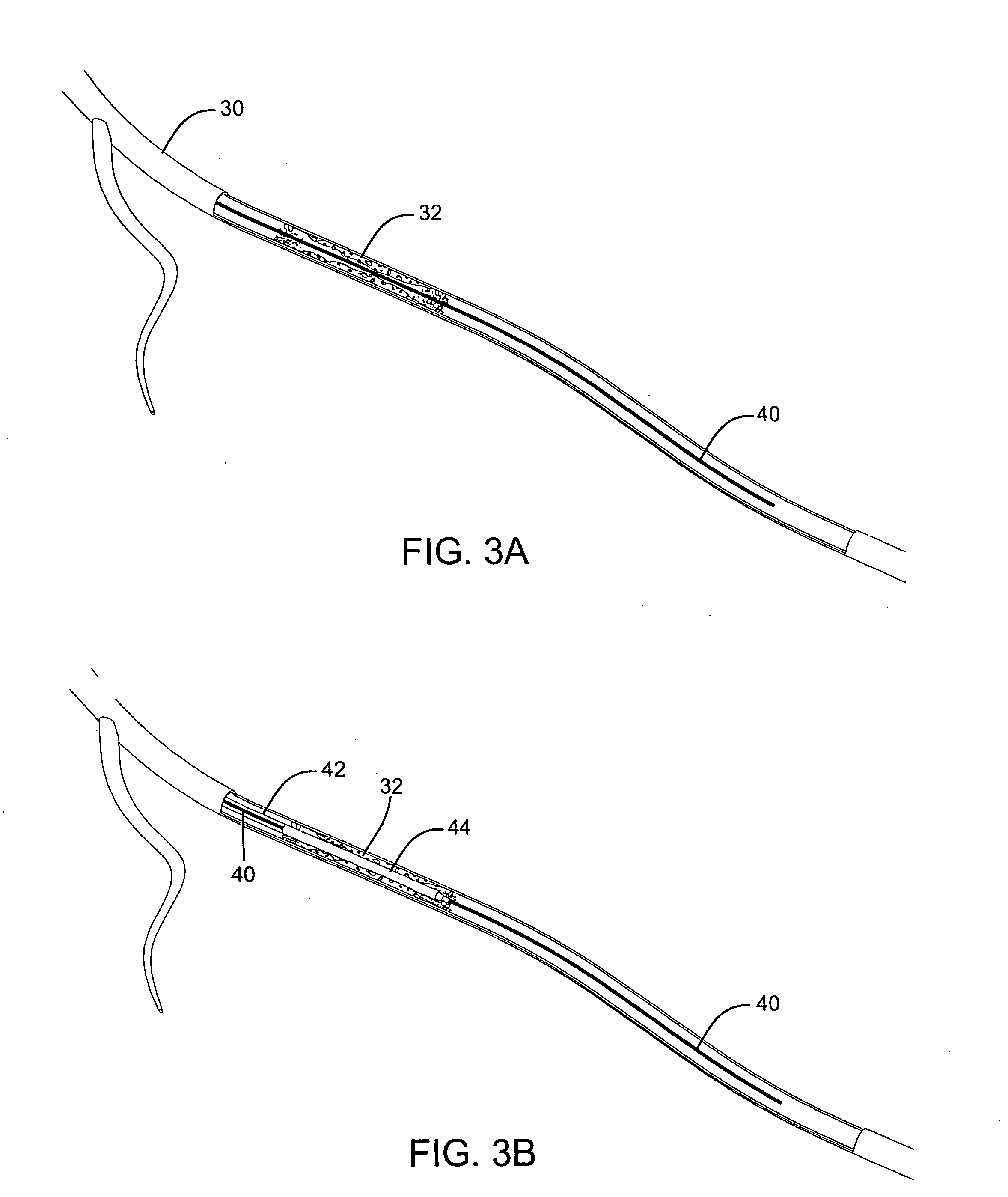 Corewire actuated delivery system with fixed distal stent-carrying extension