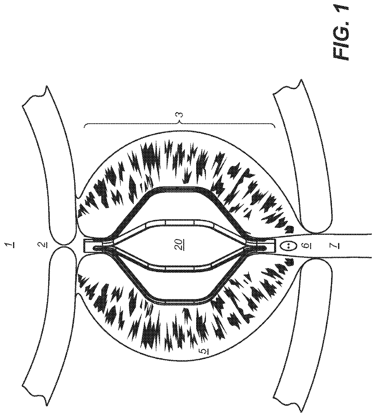 Implantable devices and methods to treat benign prostate hyperplasia (BPH) and associated lower urinary tract symptoms (LUTS)