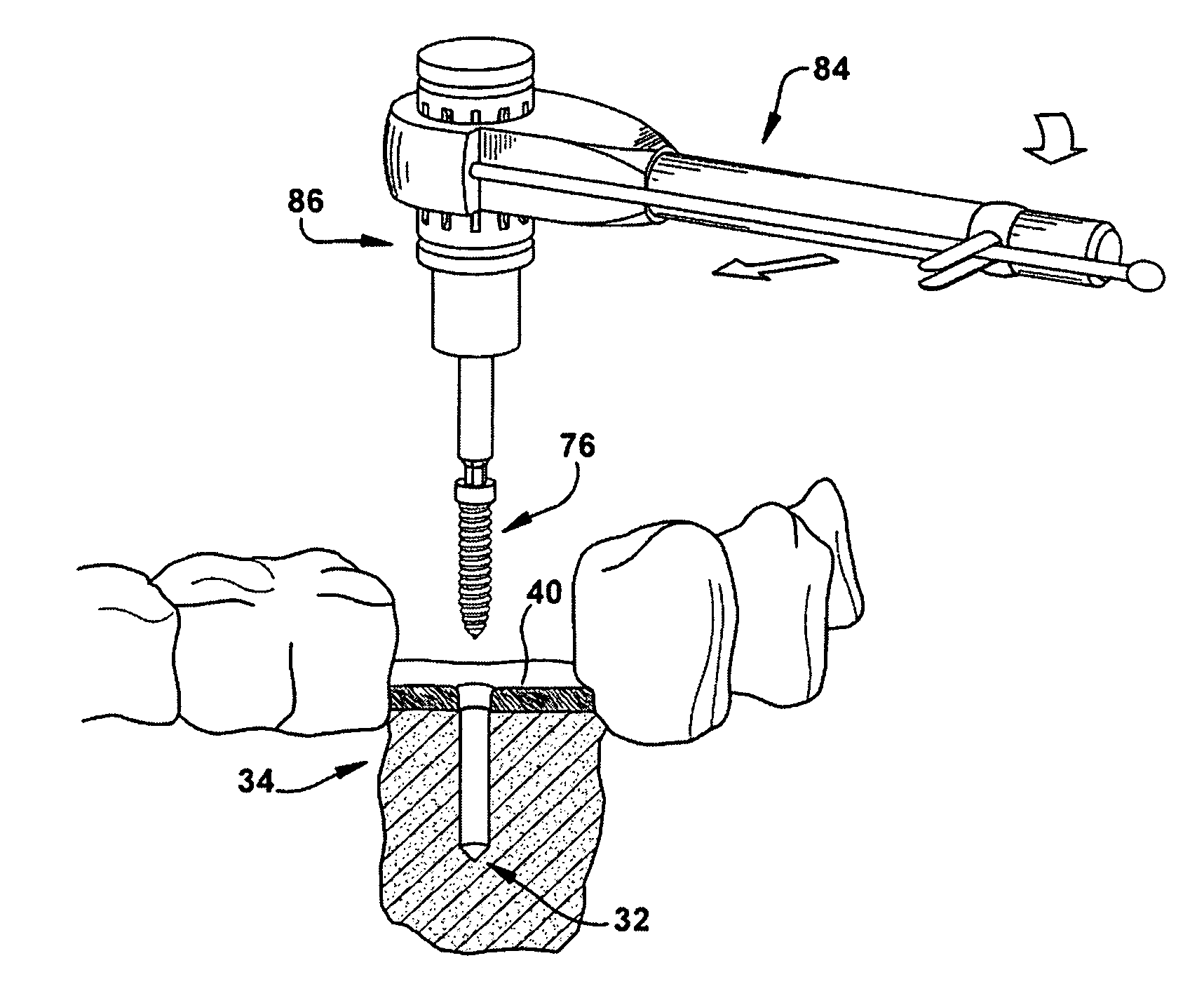 Method for forming a dental implant