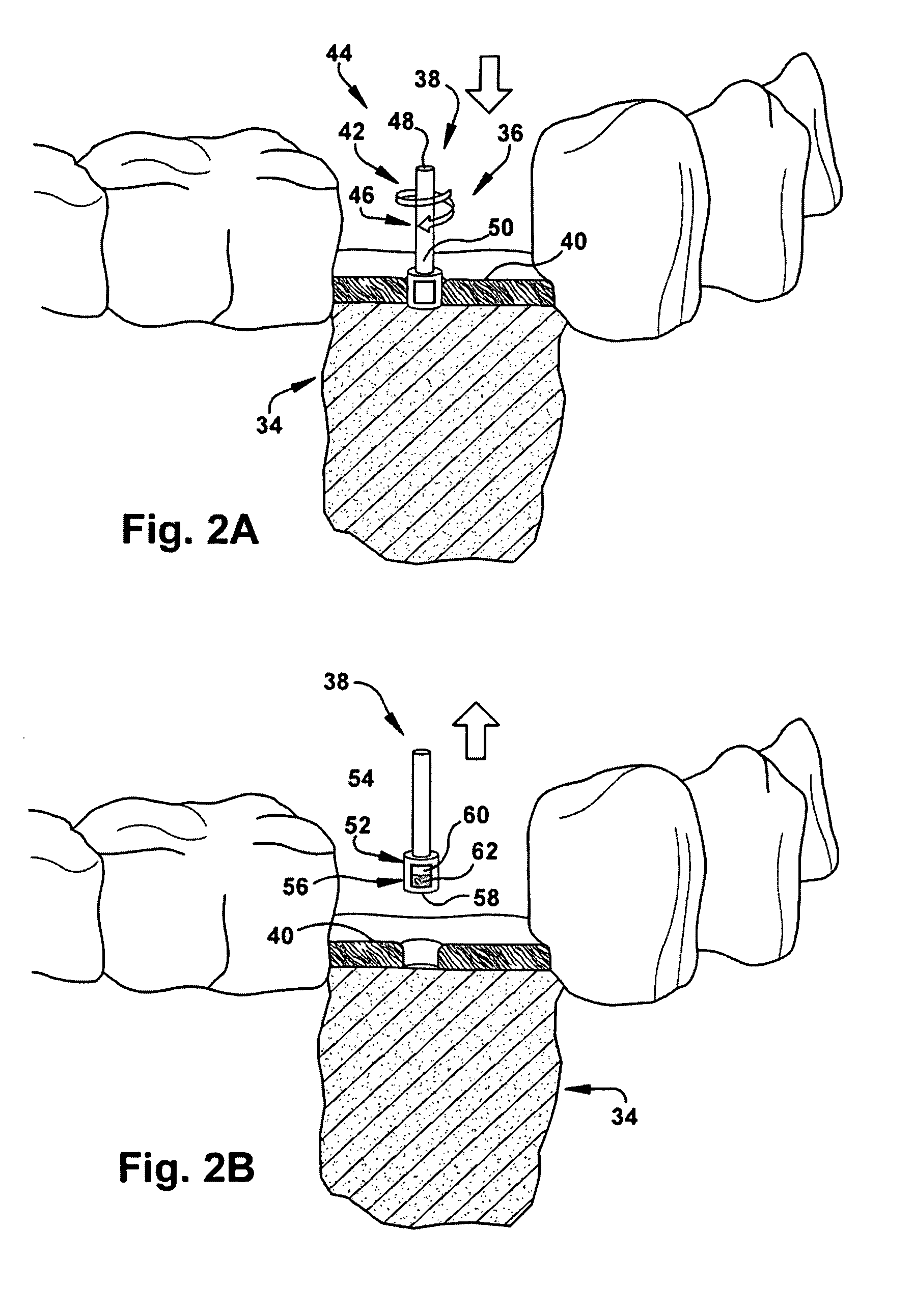 Method for forming a dental implant