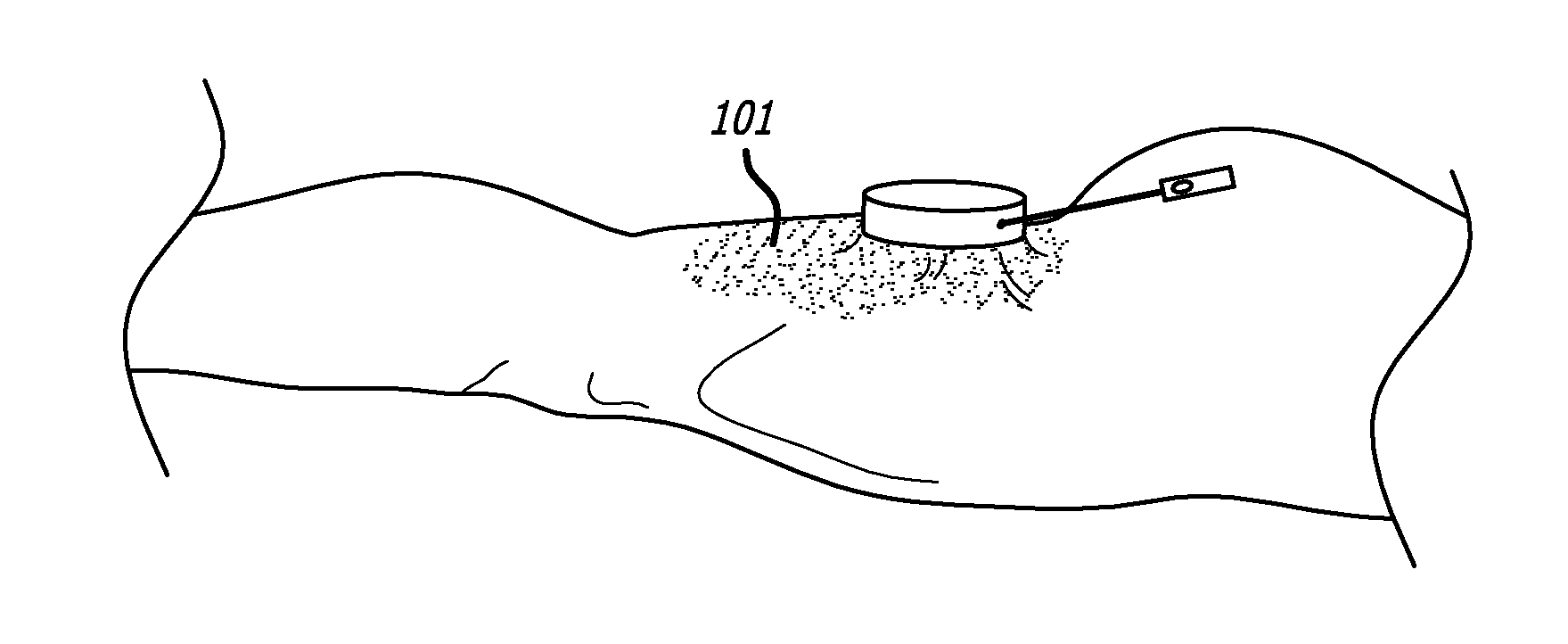 Devices and methods for performing subcutaneous surgery