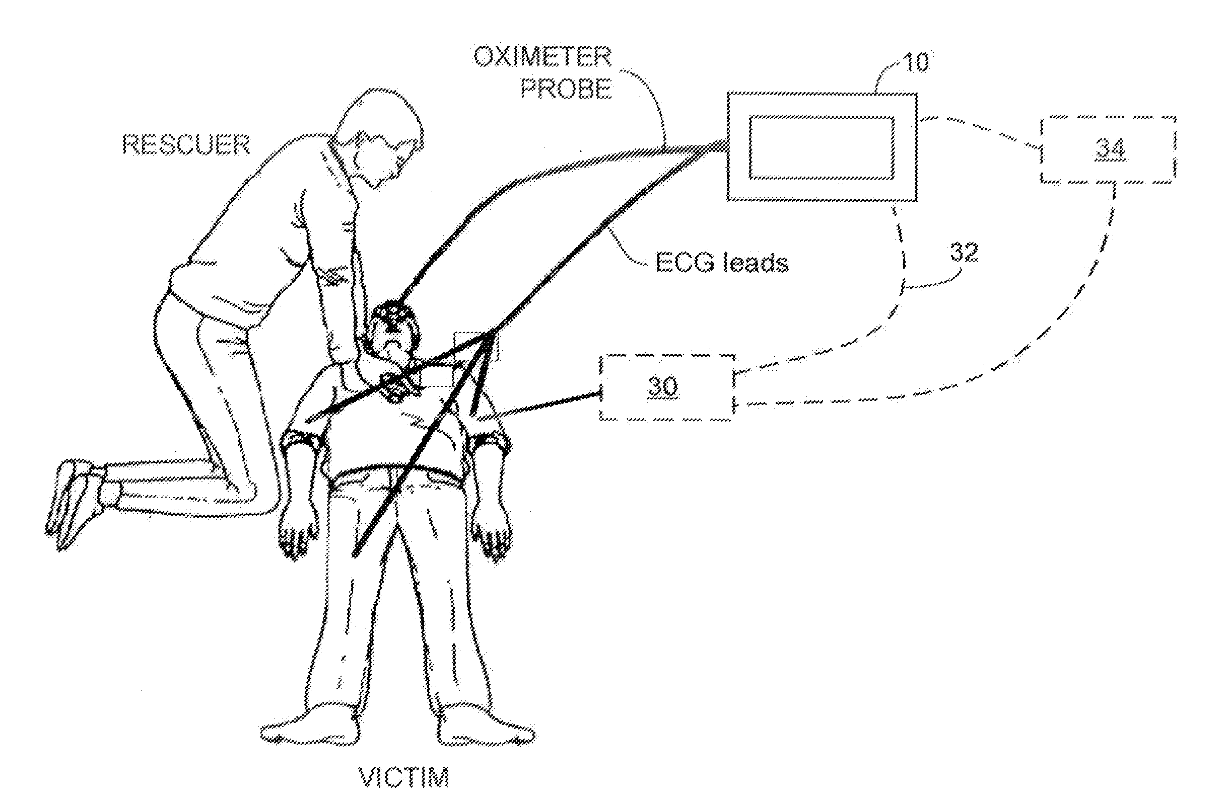 ECG Rhythm Advisory Method