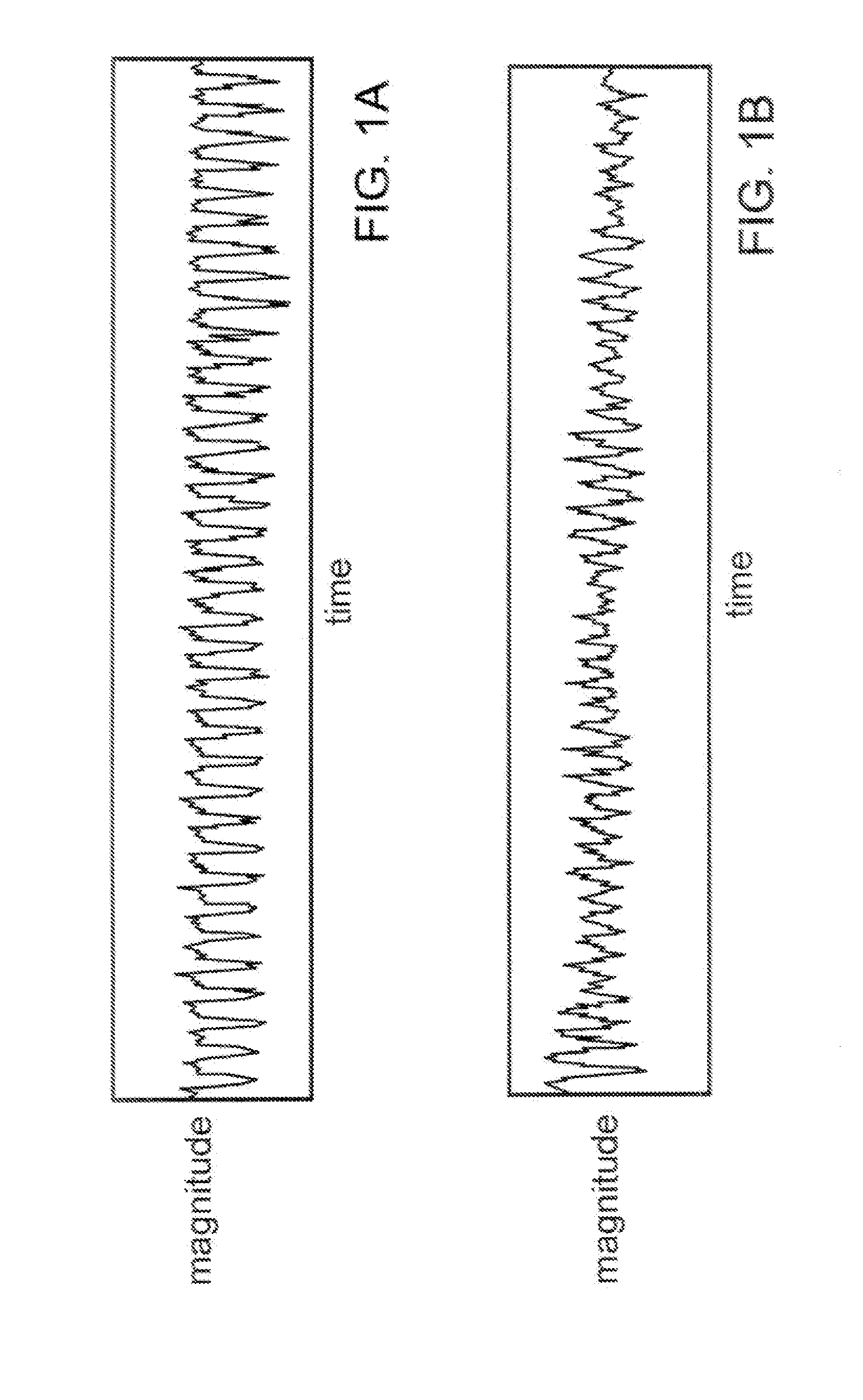 ECG Rhythm Advisory Method