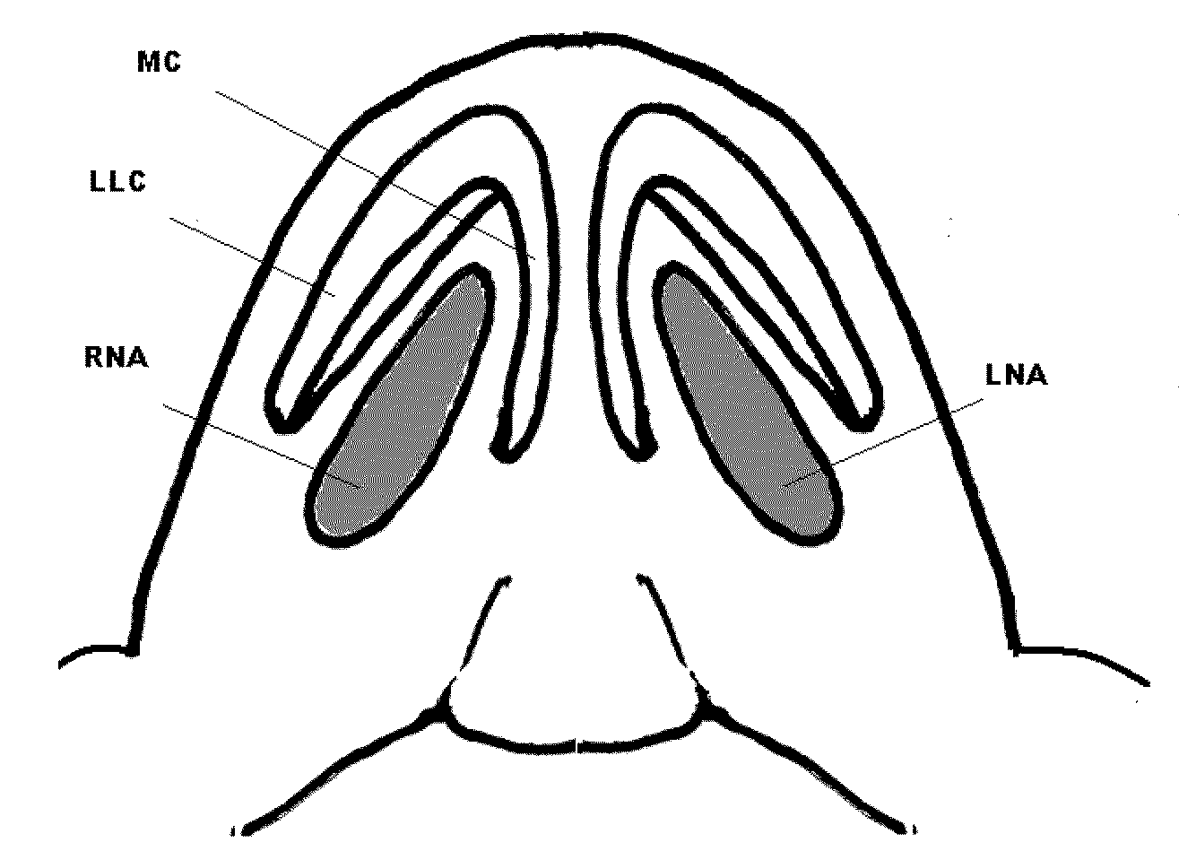 Nasal implant introduced through a non-surgical injection technique