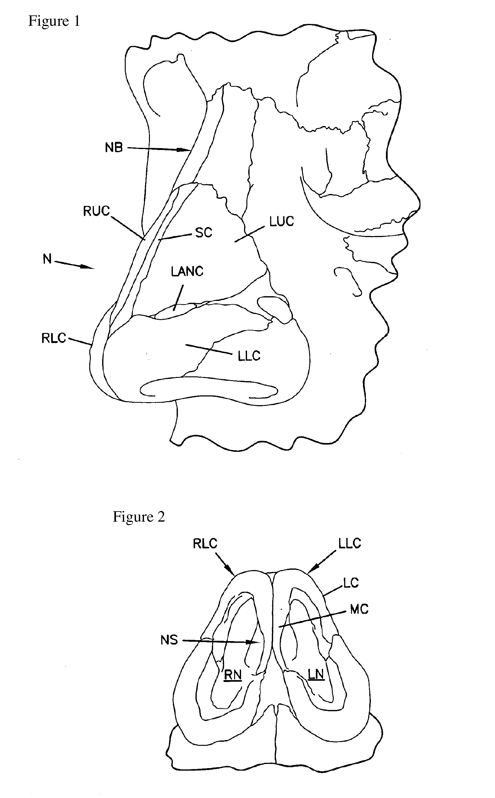 Nasal implant introduced through a non-surgical injection technique