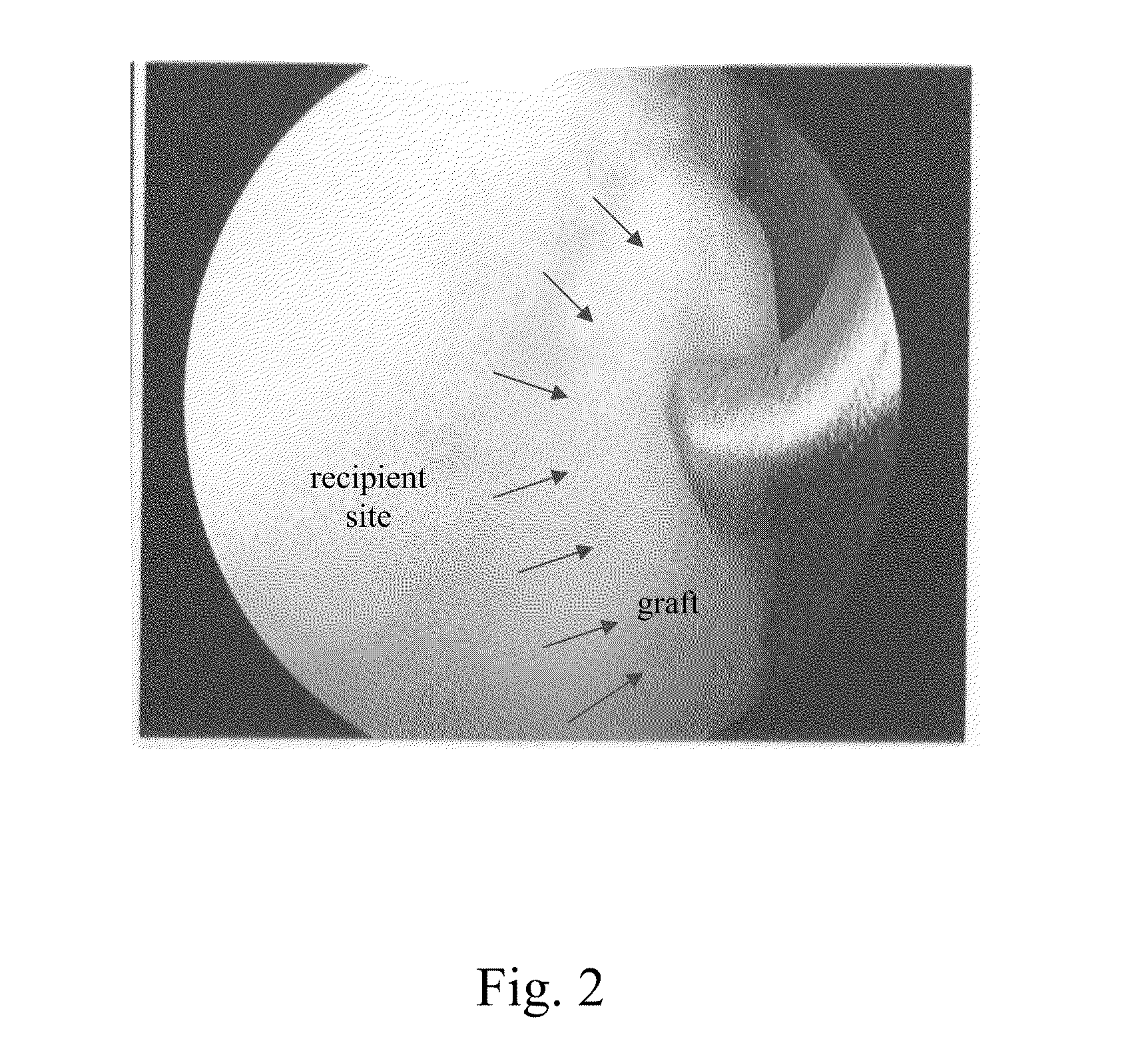 Surgical grafts for repairing chondral defects