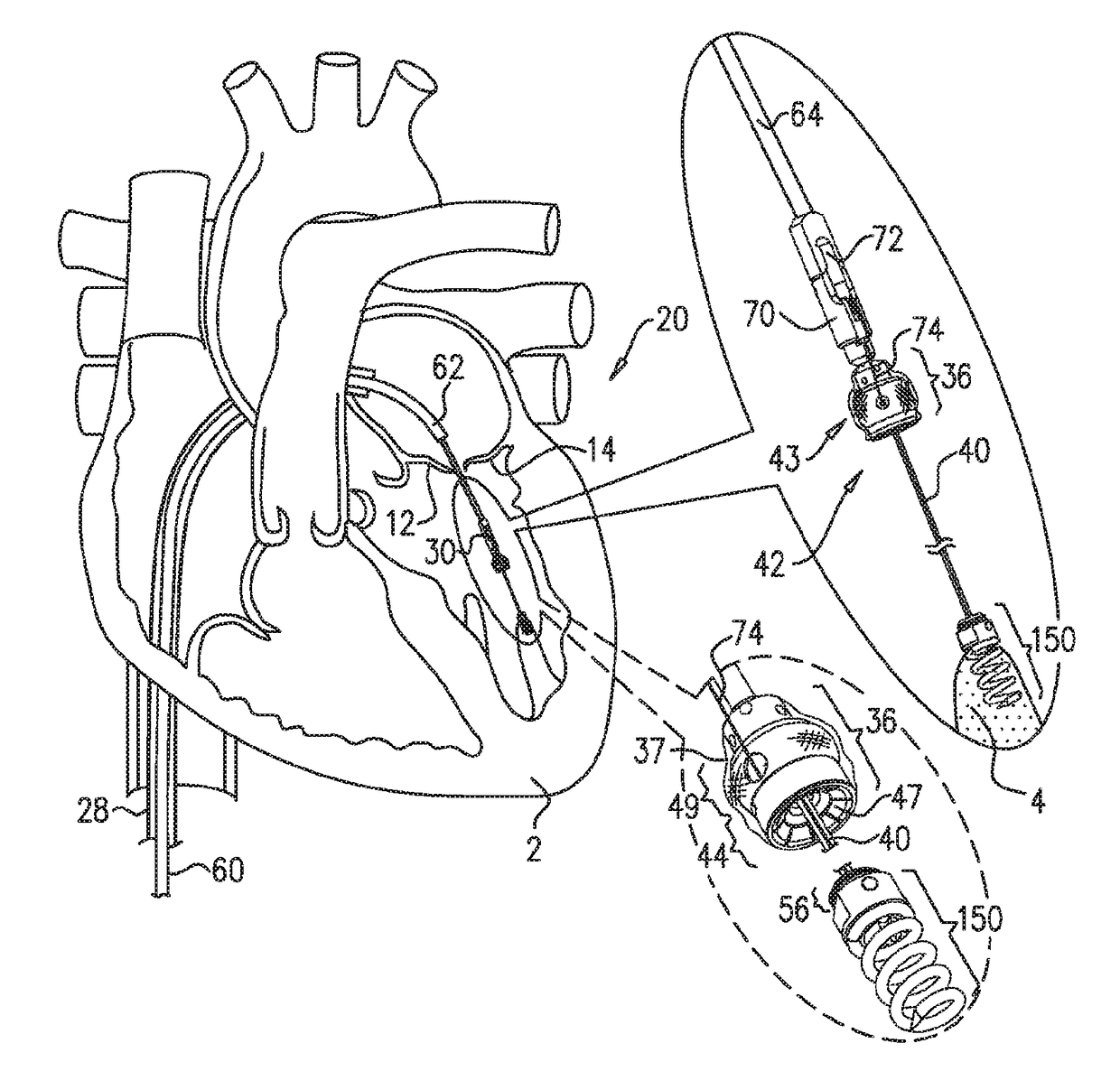 Techniques for guide-wire based advancement of a tool