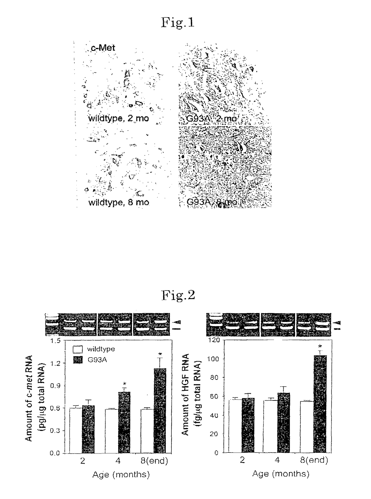 Methods of treating amyotrophic lateral sclerosis by HGF