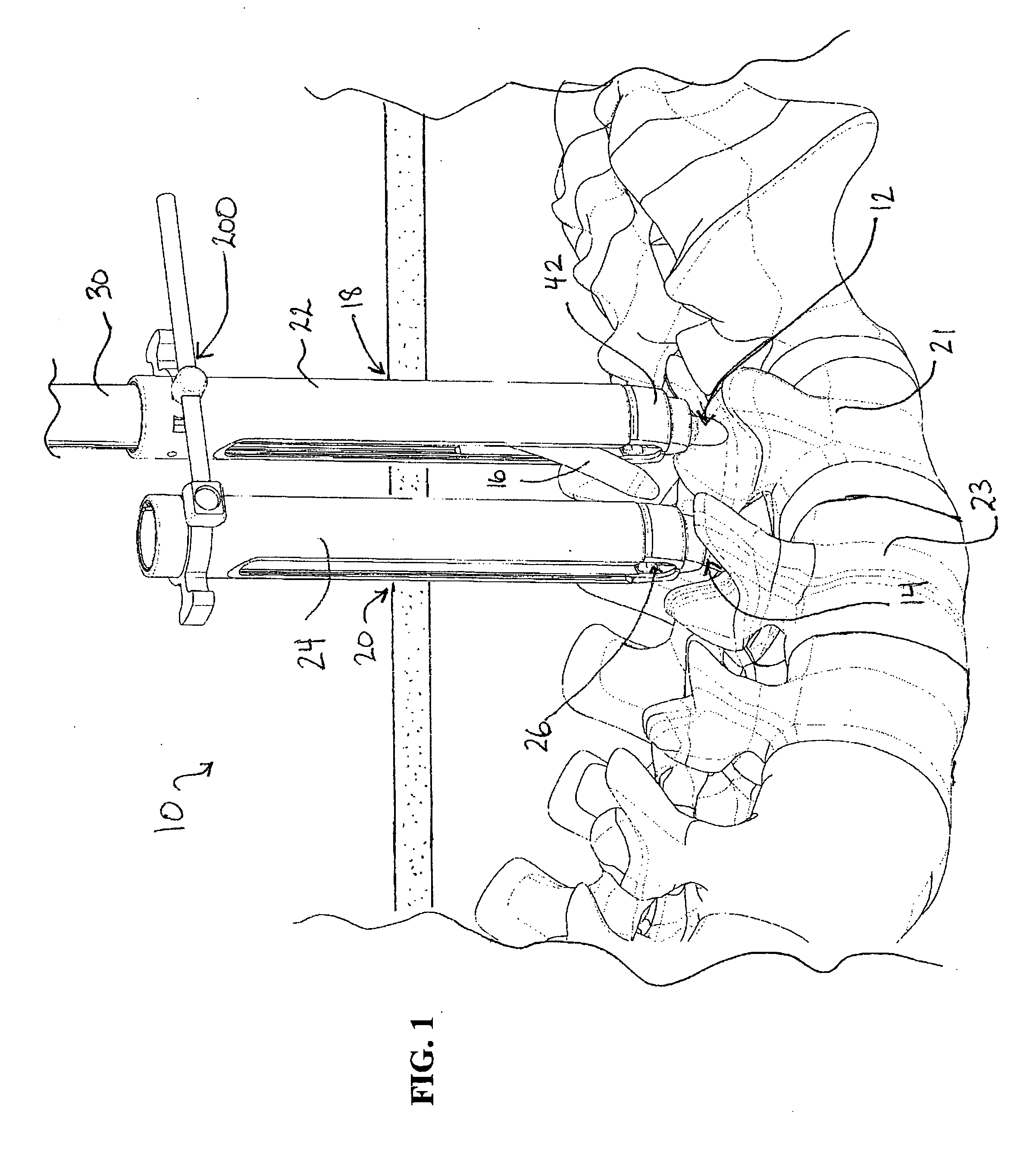 Percutaneous vertebral stabilization system