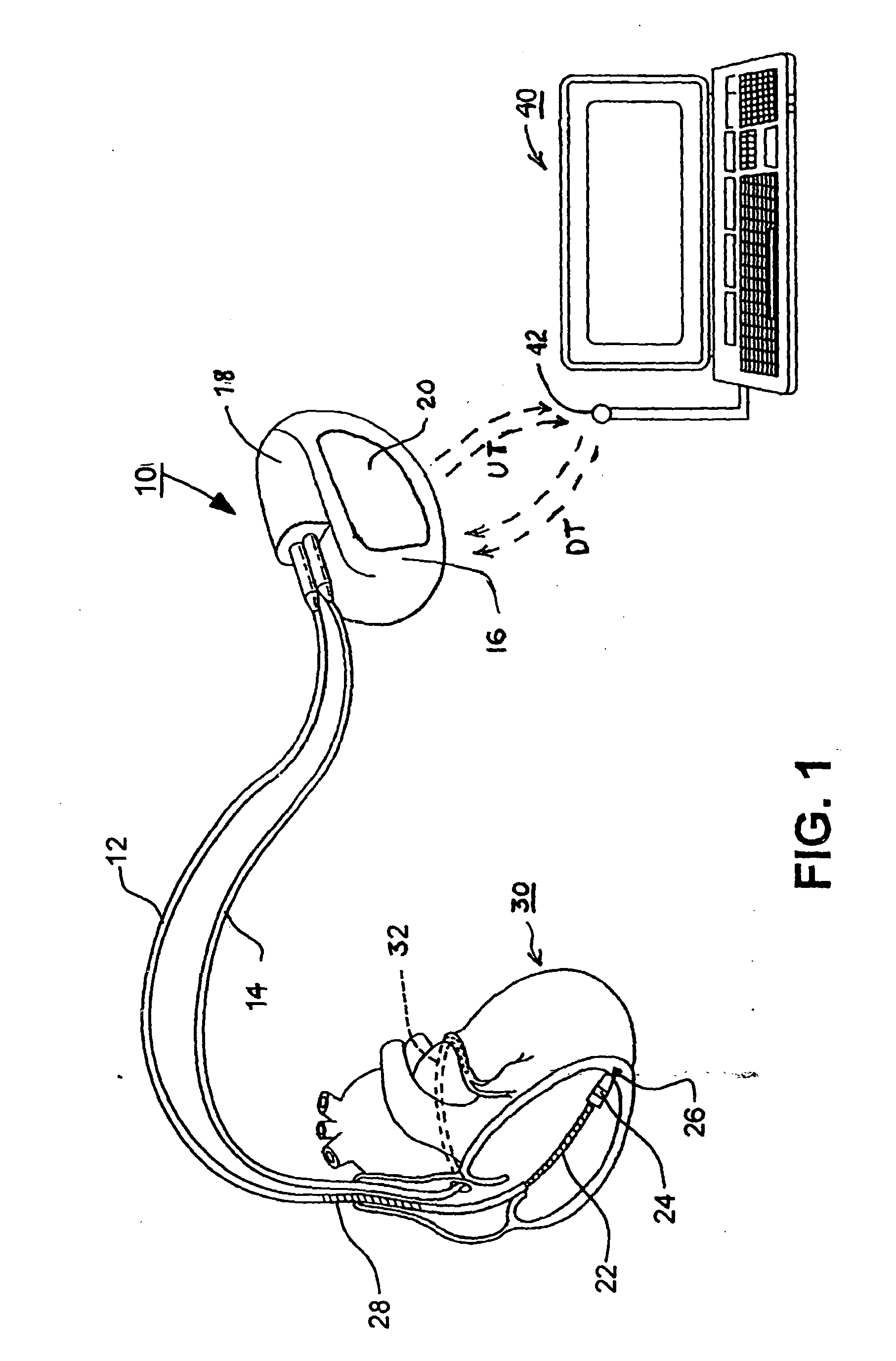 Methods and apparatus for discriminating polymorphic tachyarrhythmias from monomorphic tachyarrhythmias facilitating detection of fibrillation