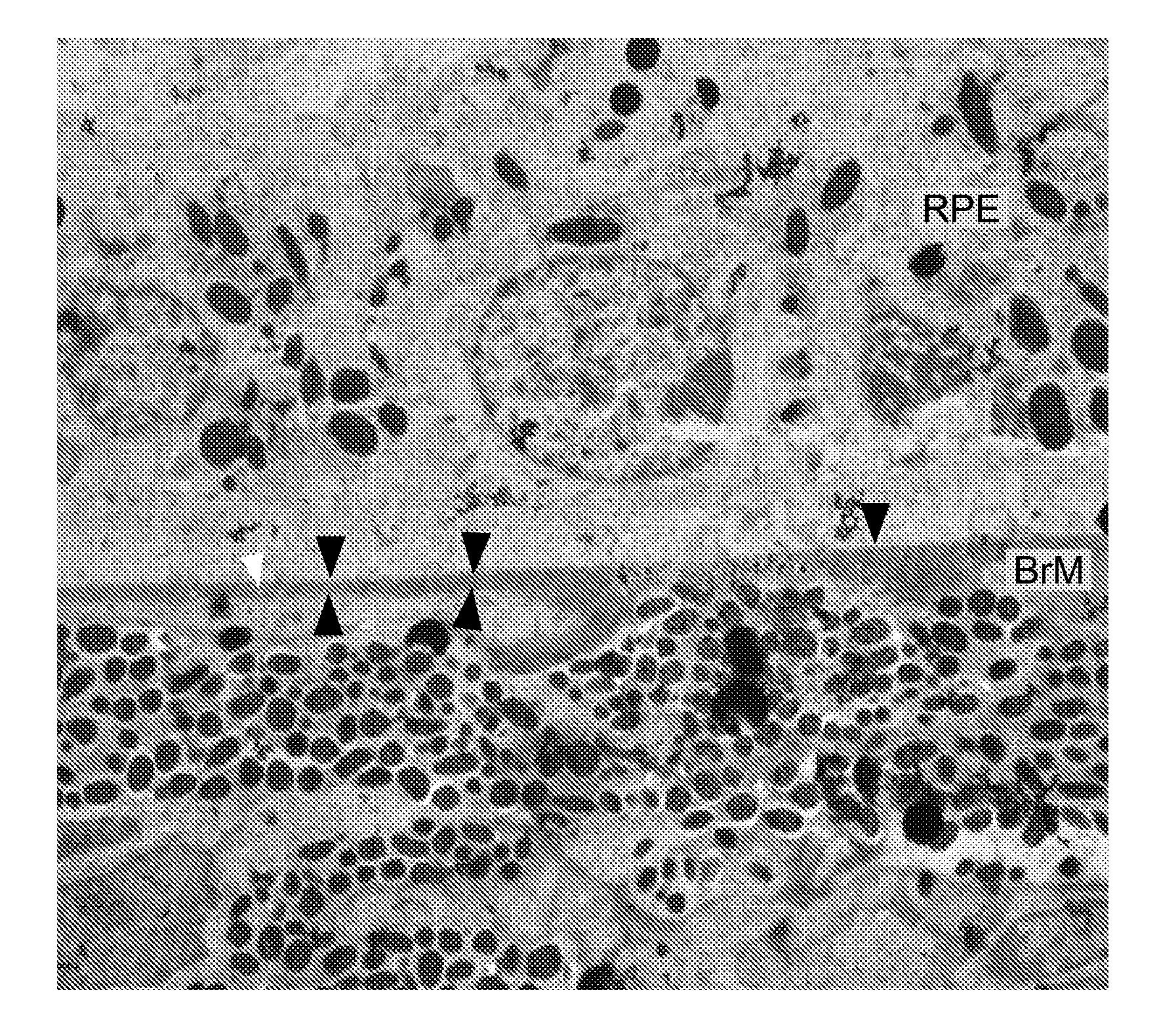 Peptides and peptide mimetics to treat pathologies associated with eye disease