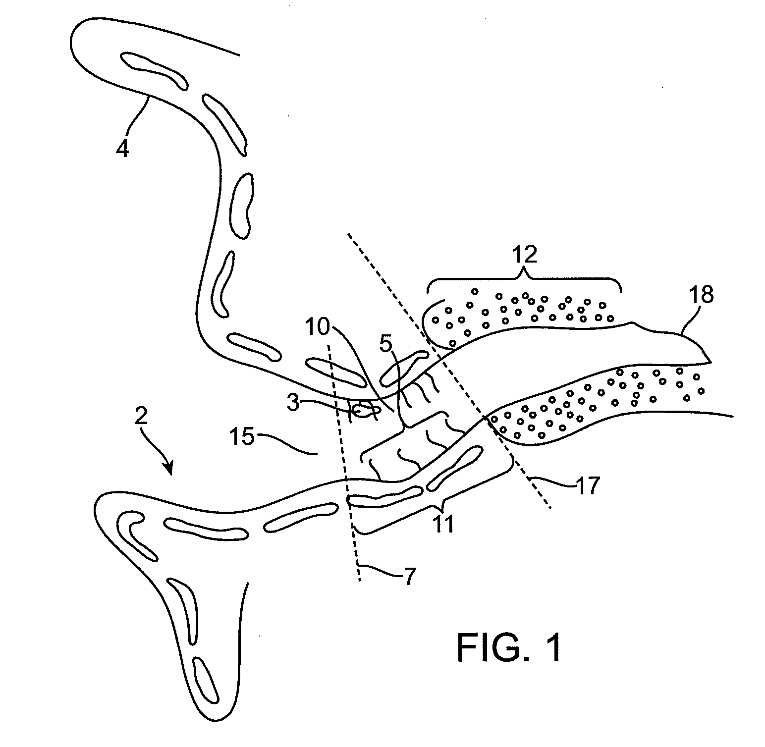 Combined microphone and receiver assembly for extended wear canal hearing devices