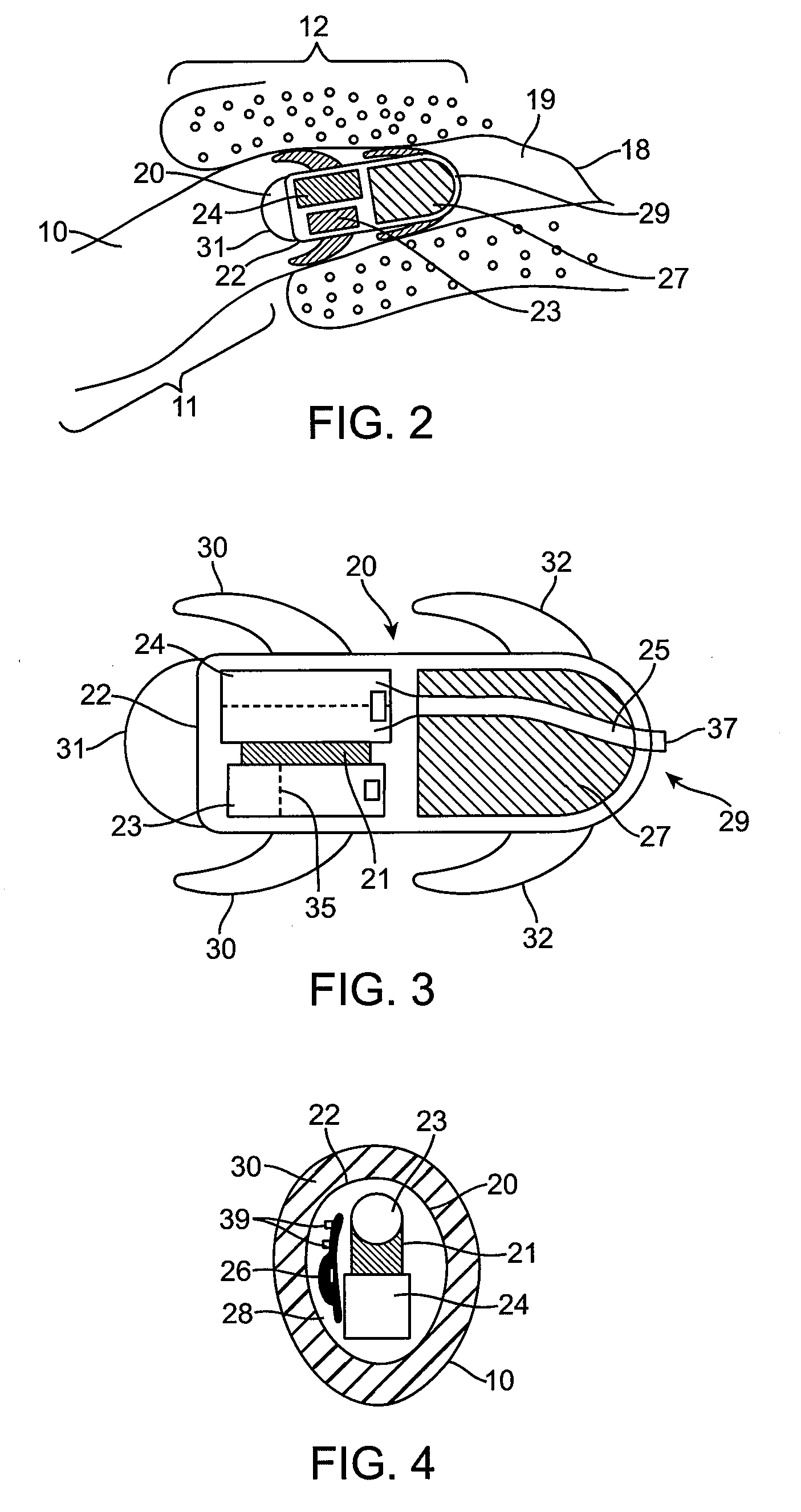 Combined microphone and receiver assembly for extended wear canal hearing devices