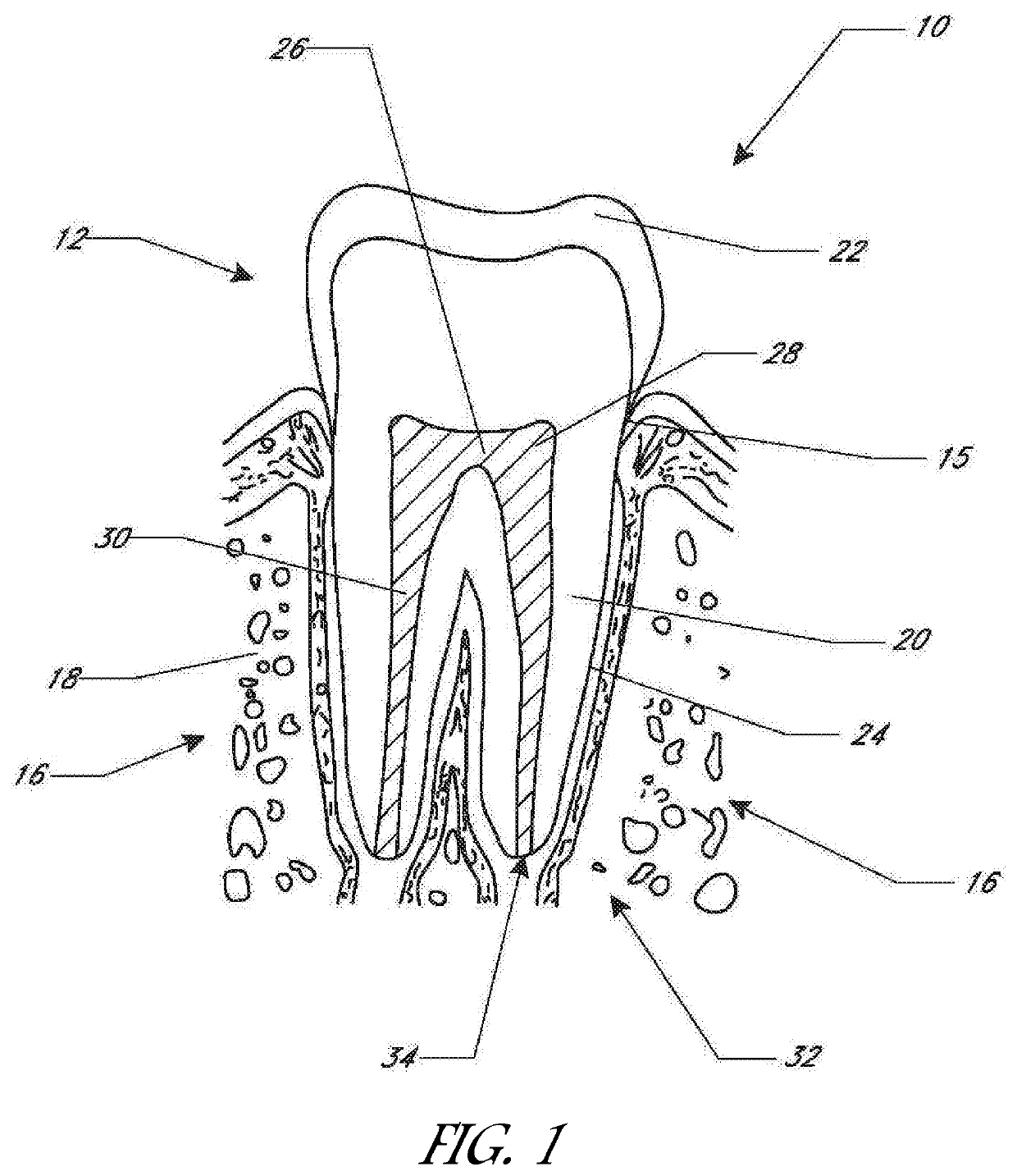 Apparatus and method for treating teeth