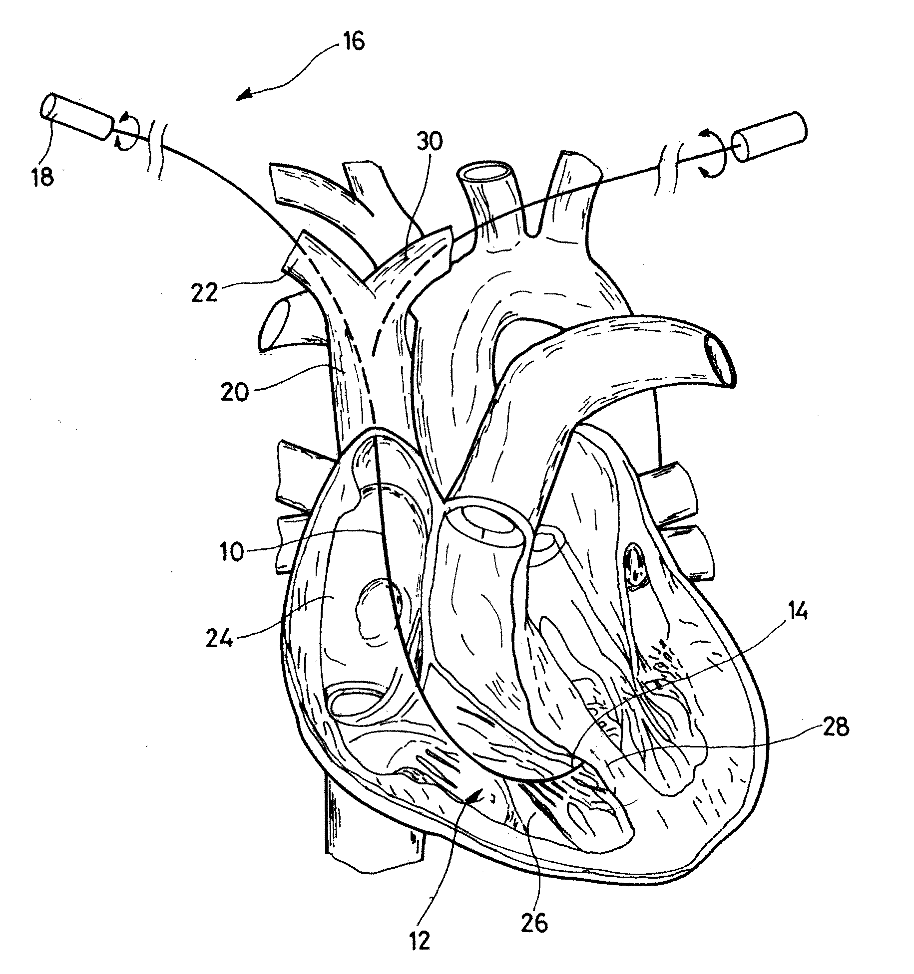 Preformed stylet for guiding a lead to contact the septum