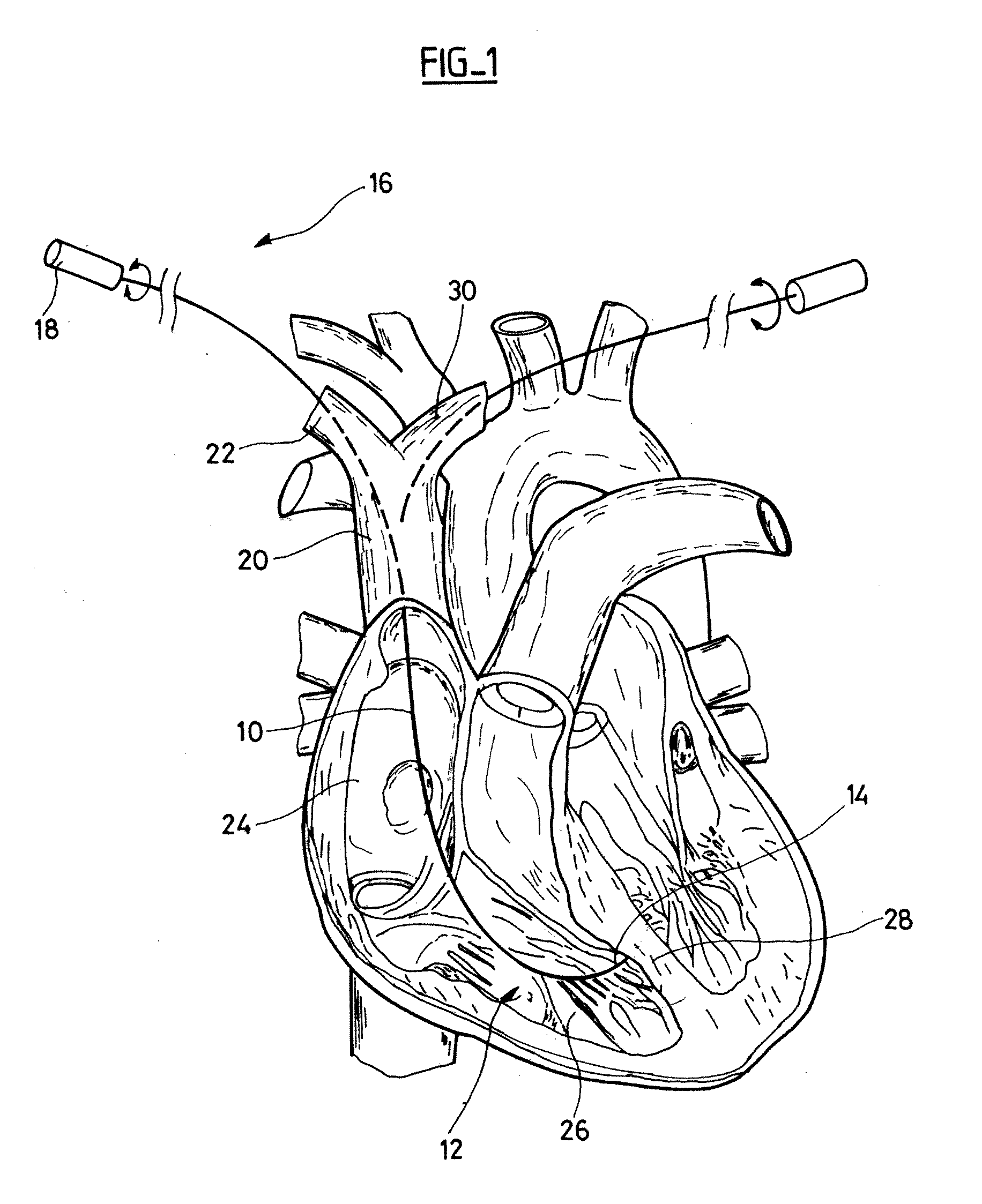 Preformed stylet for guiding a lead to contact the septum