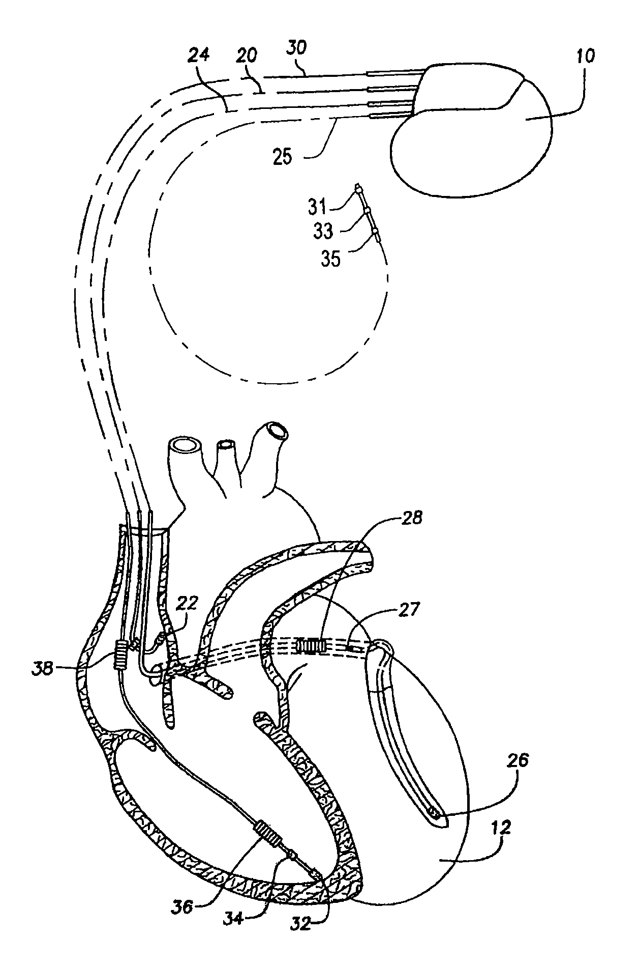 Implantable devices, and methods for use therewith, for monitoring sympathetic and parasympathetic influences on the heart