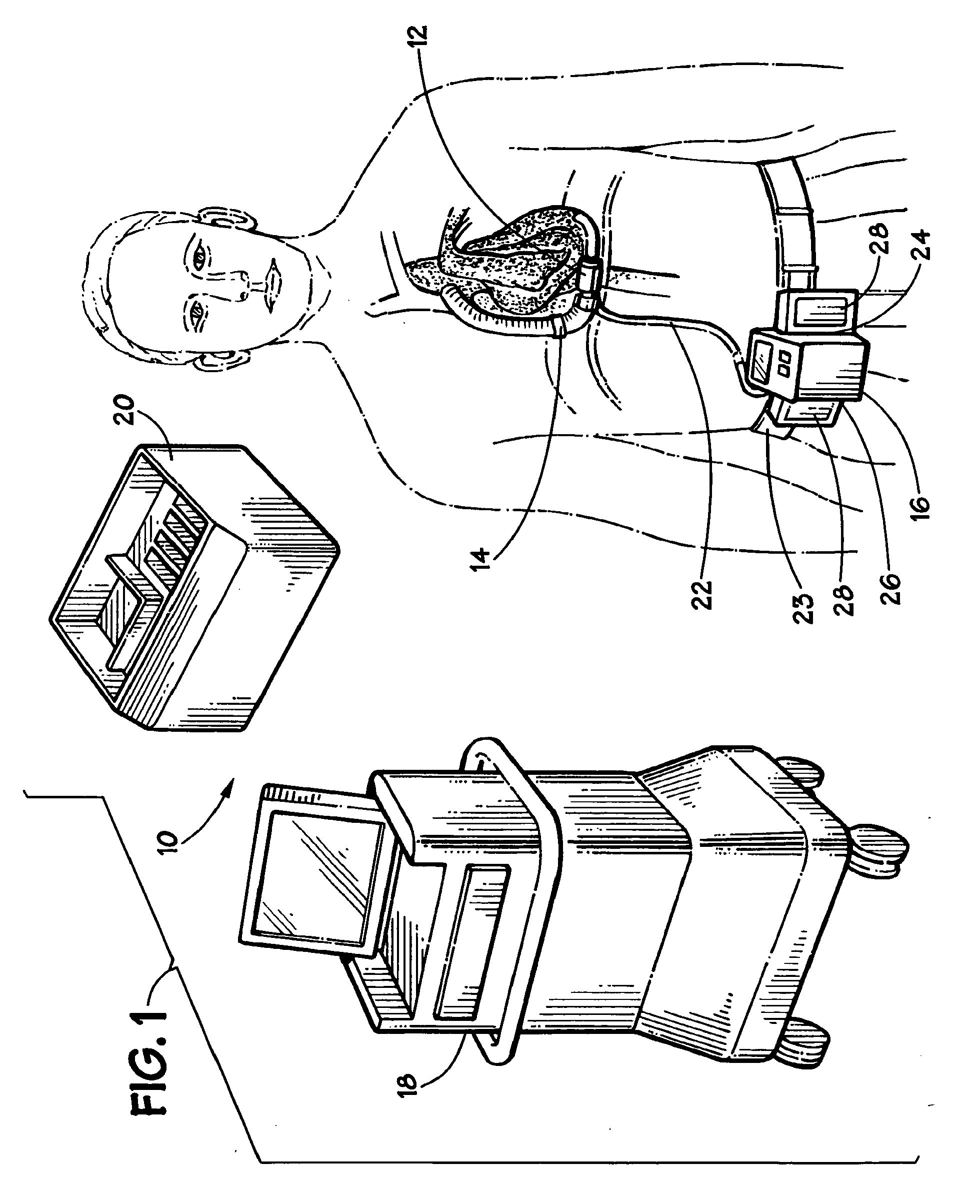 Blood pump system and method of operation