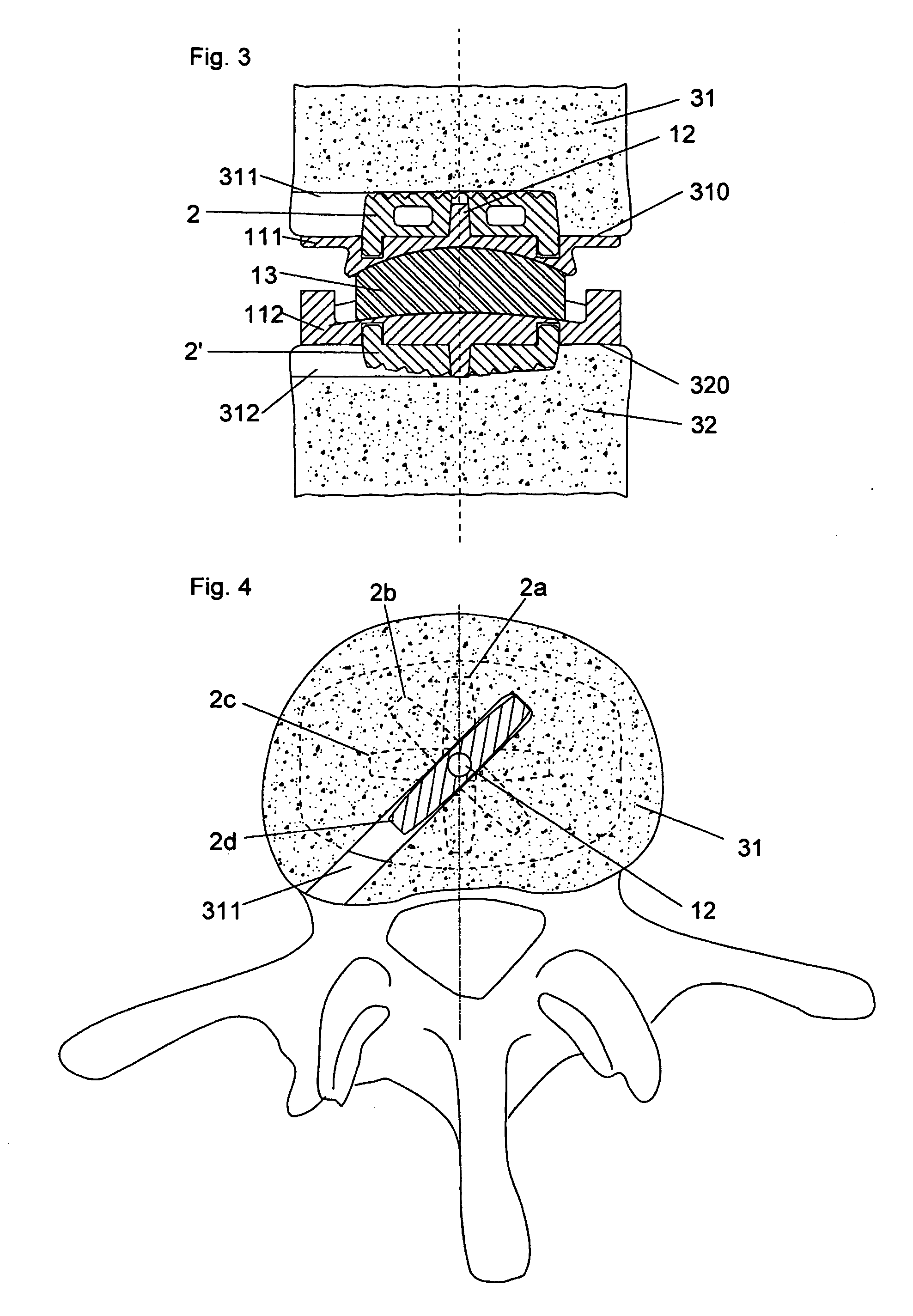 Osseous achoring device for a prosthesis