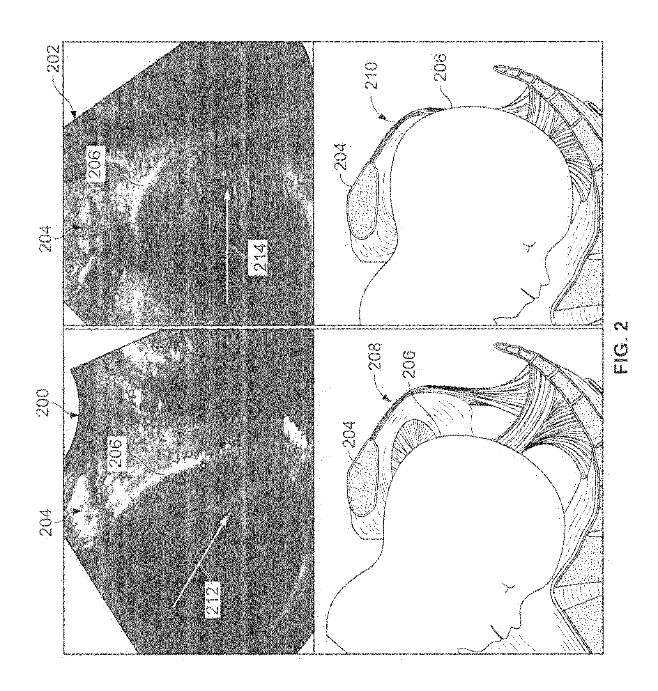 Method and apparatus for evaluation of labor with ultrasound