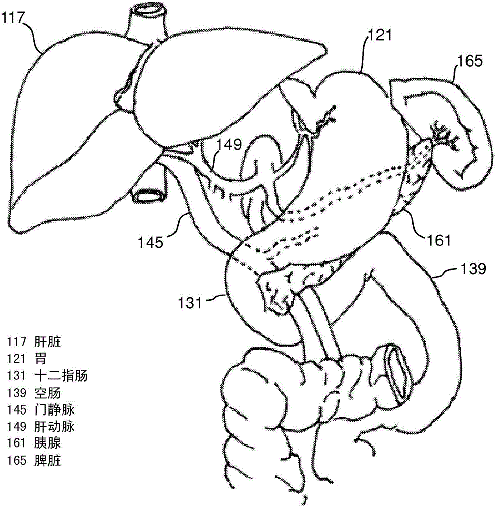 Devices and methods for intrahepatic shunts