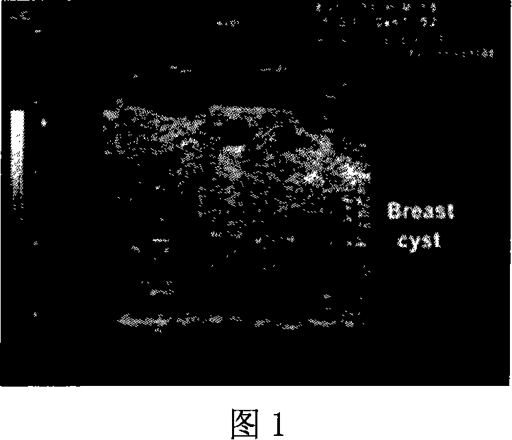 Medical ultrasonic image compression method based on the mixed wavelet coding