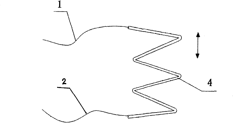 All-fiber precision variable optical attenuator