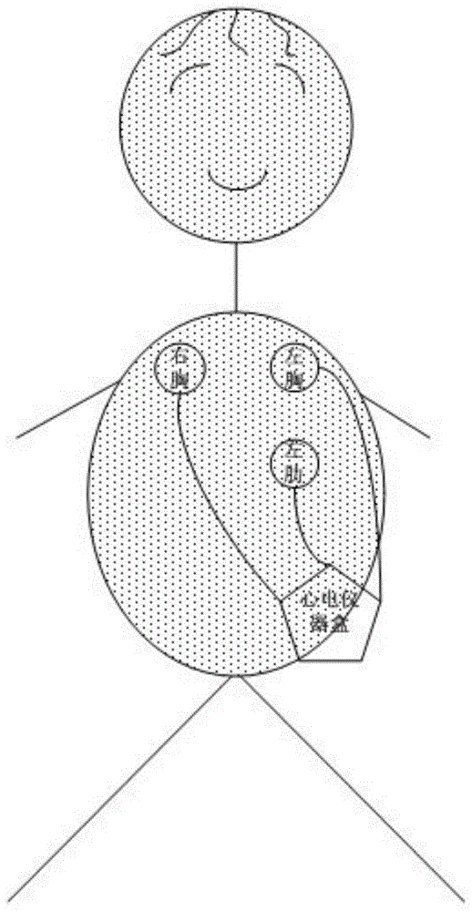 Wireless portable and wearable ECG detector capable of suppressing motion interference