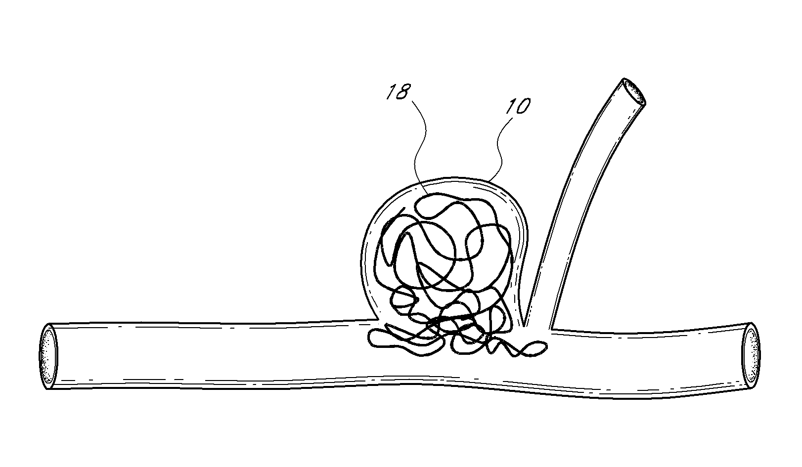 Vascular remodeling device