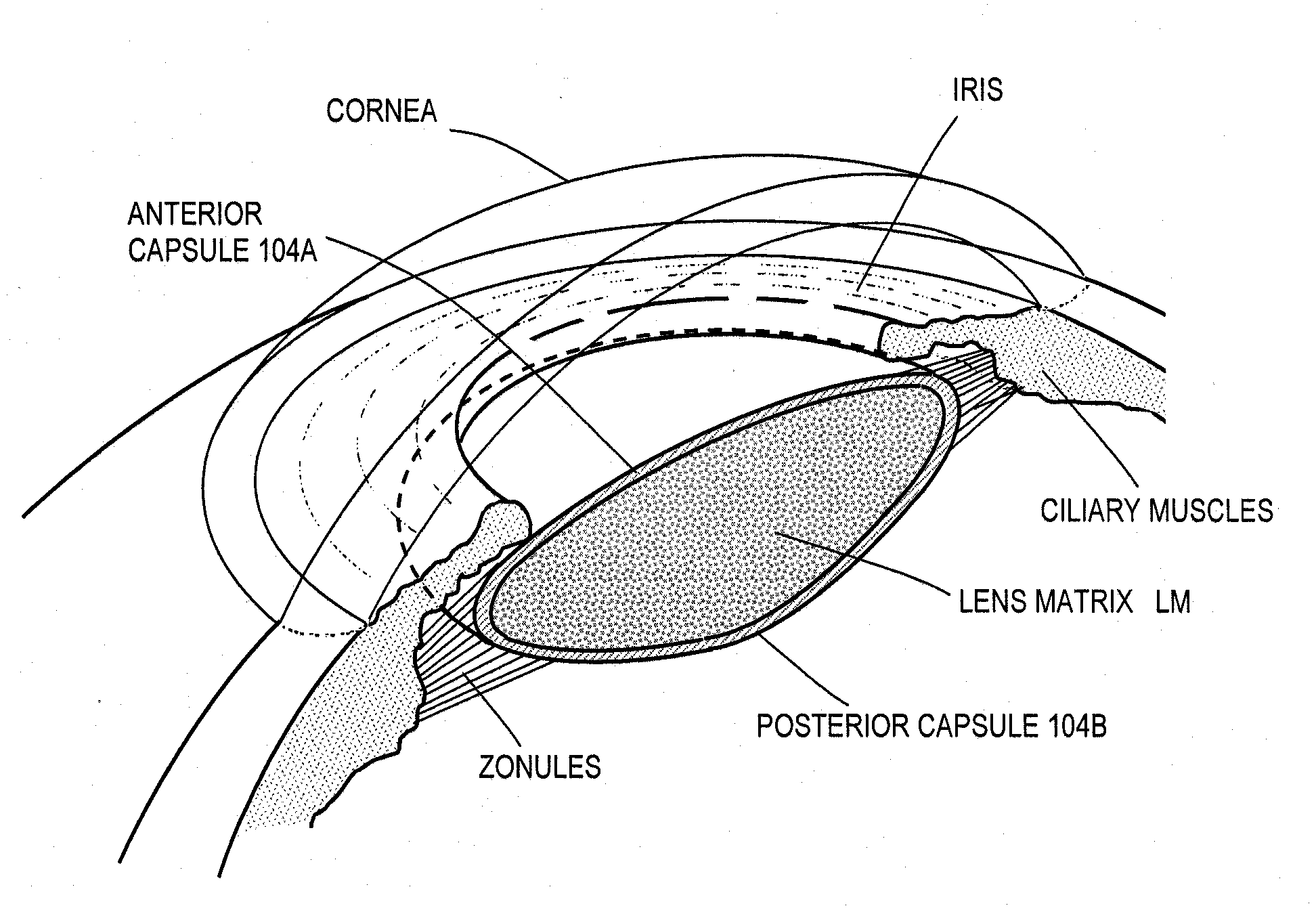 Intraocular Lenses and Business Methods