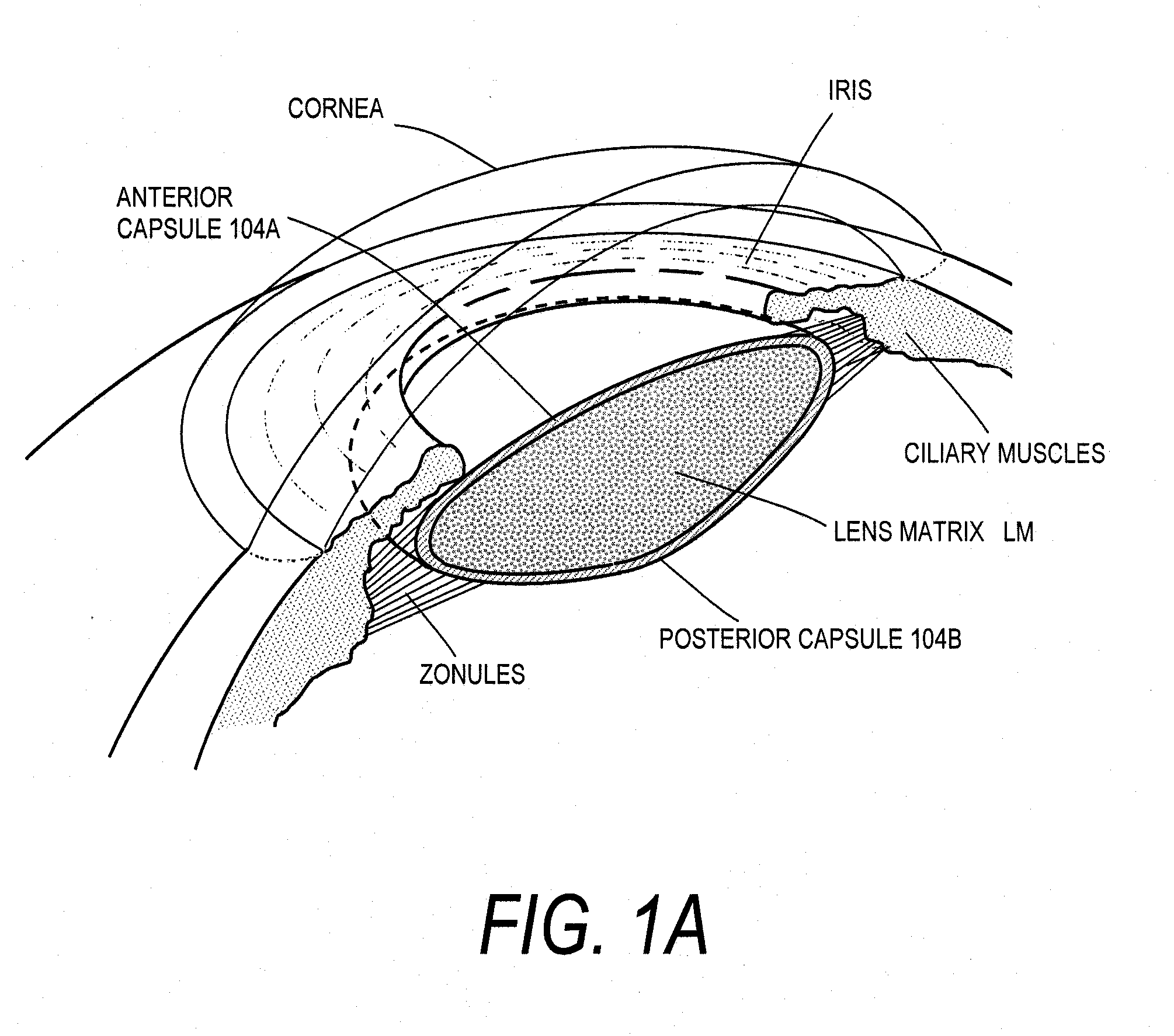 Intraocular Lenses and Business Methods