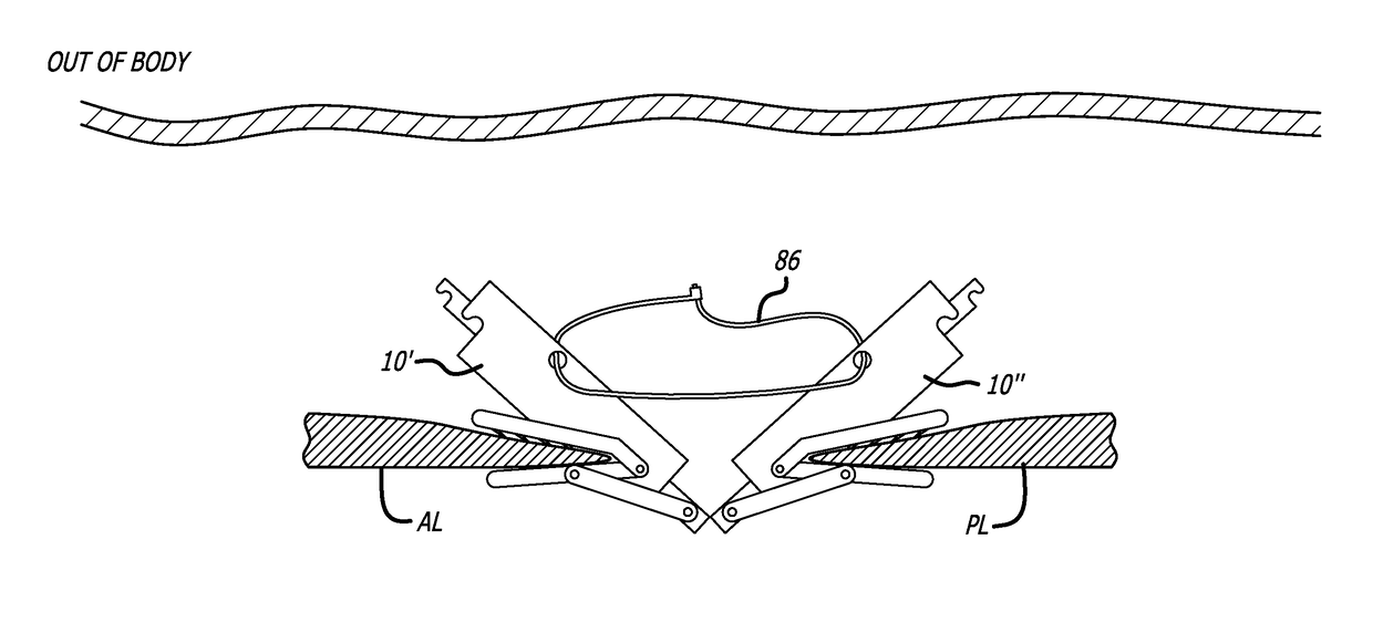 Fixation devices, systems and methods for heart valve leaf repair