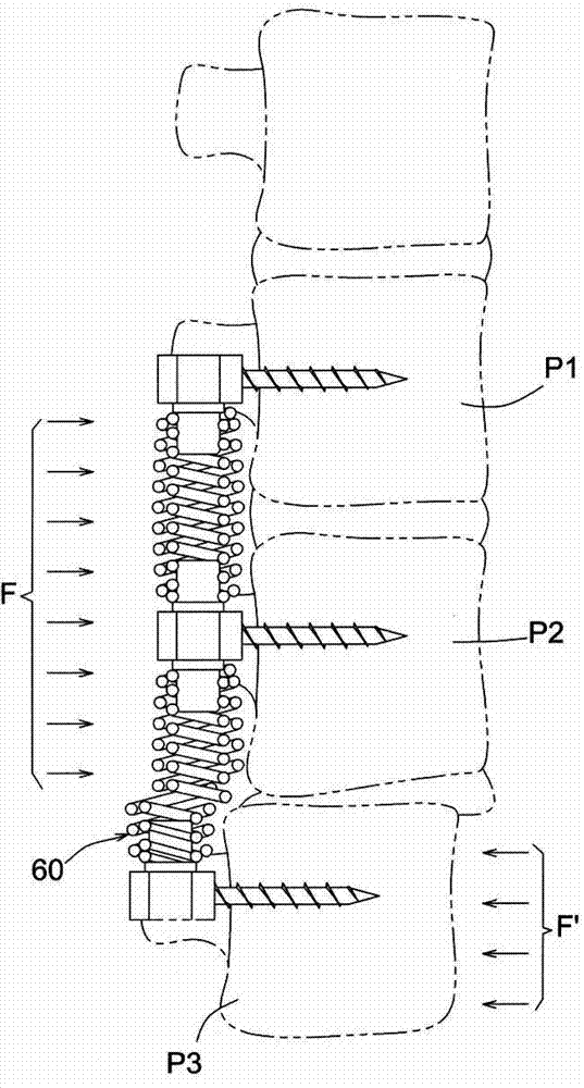 Anti-displacement coil spring-type spine stabilization device