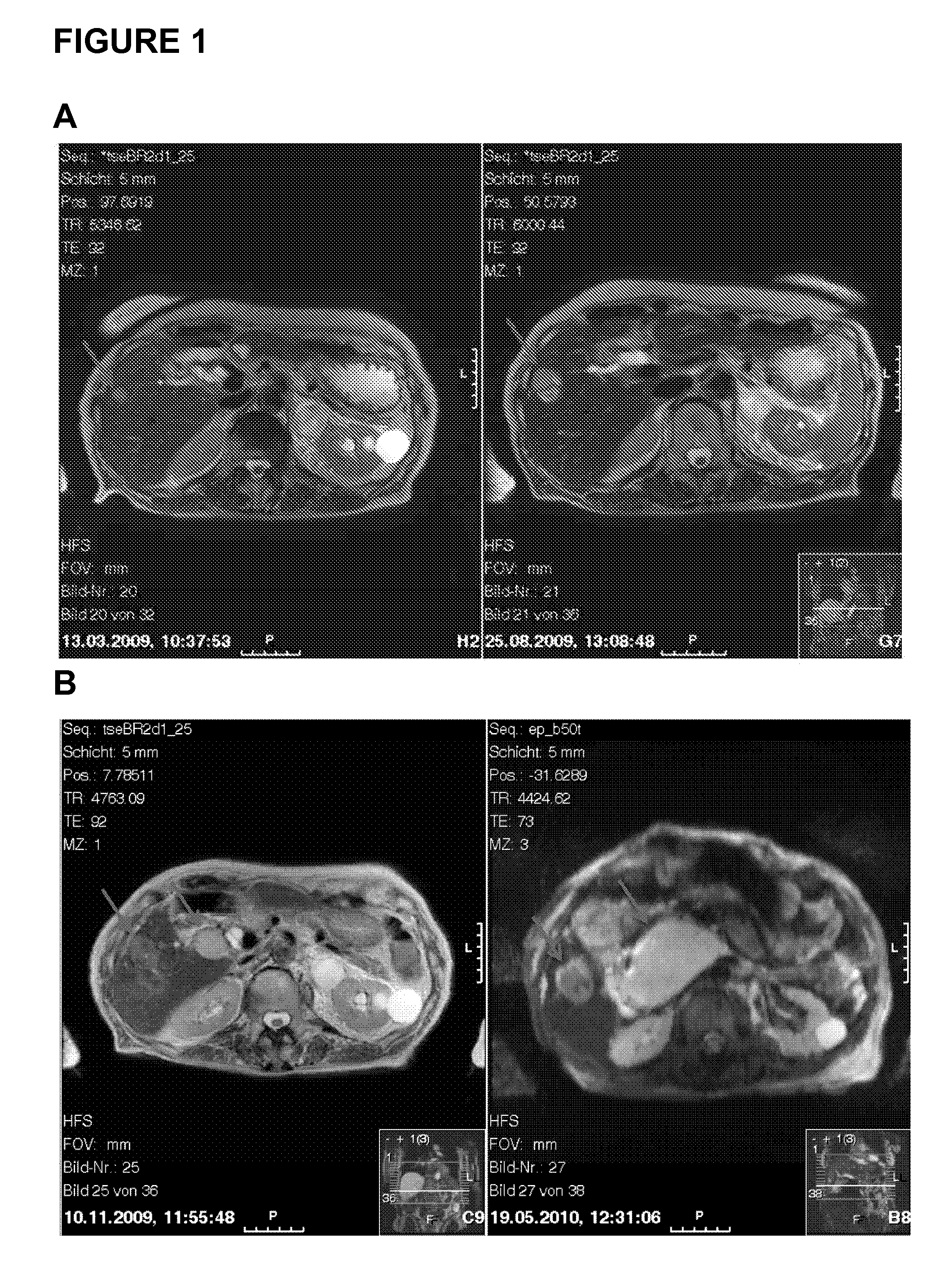 Methods and compositions for diagnosing gastrointestinal stromal tumors