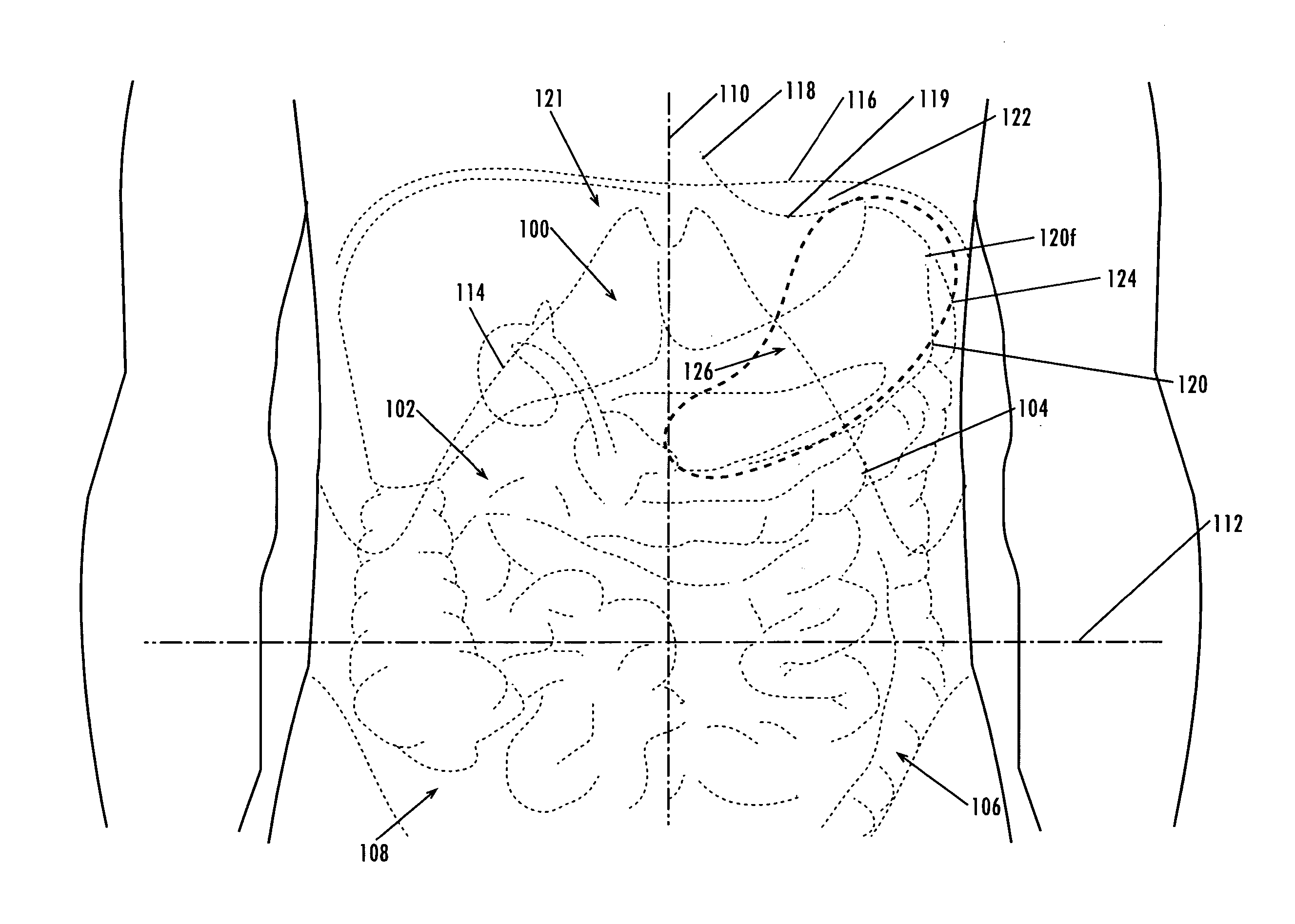 Devices and methods for treatment of obesity