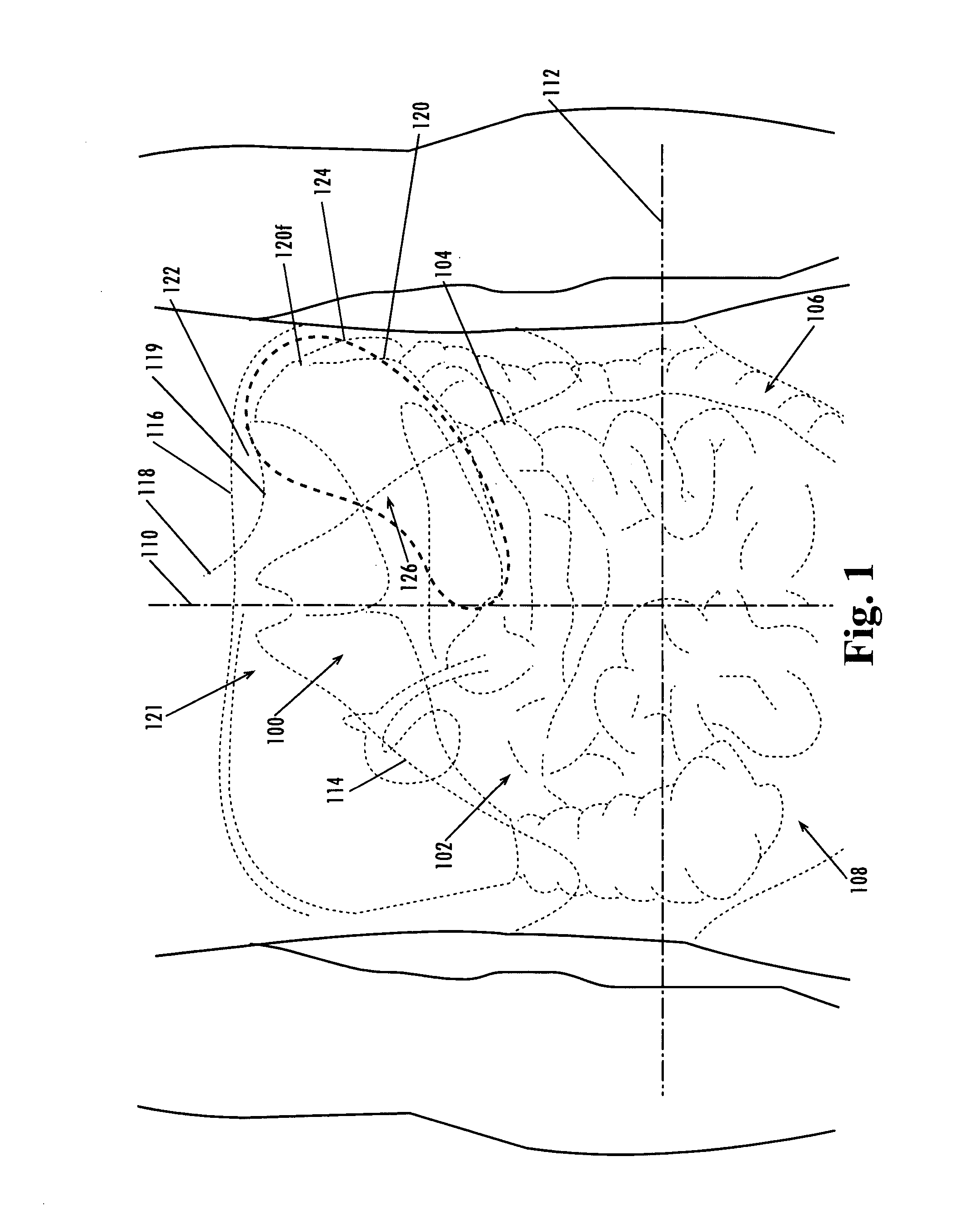 Devices and methods for treatment of obesity