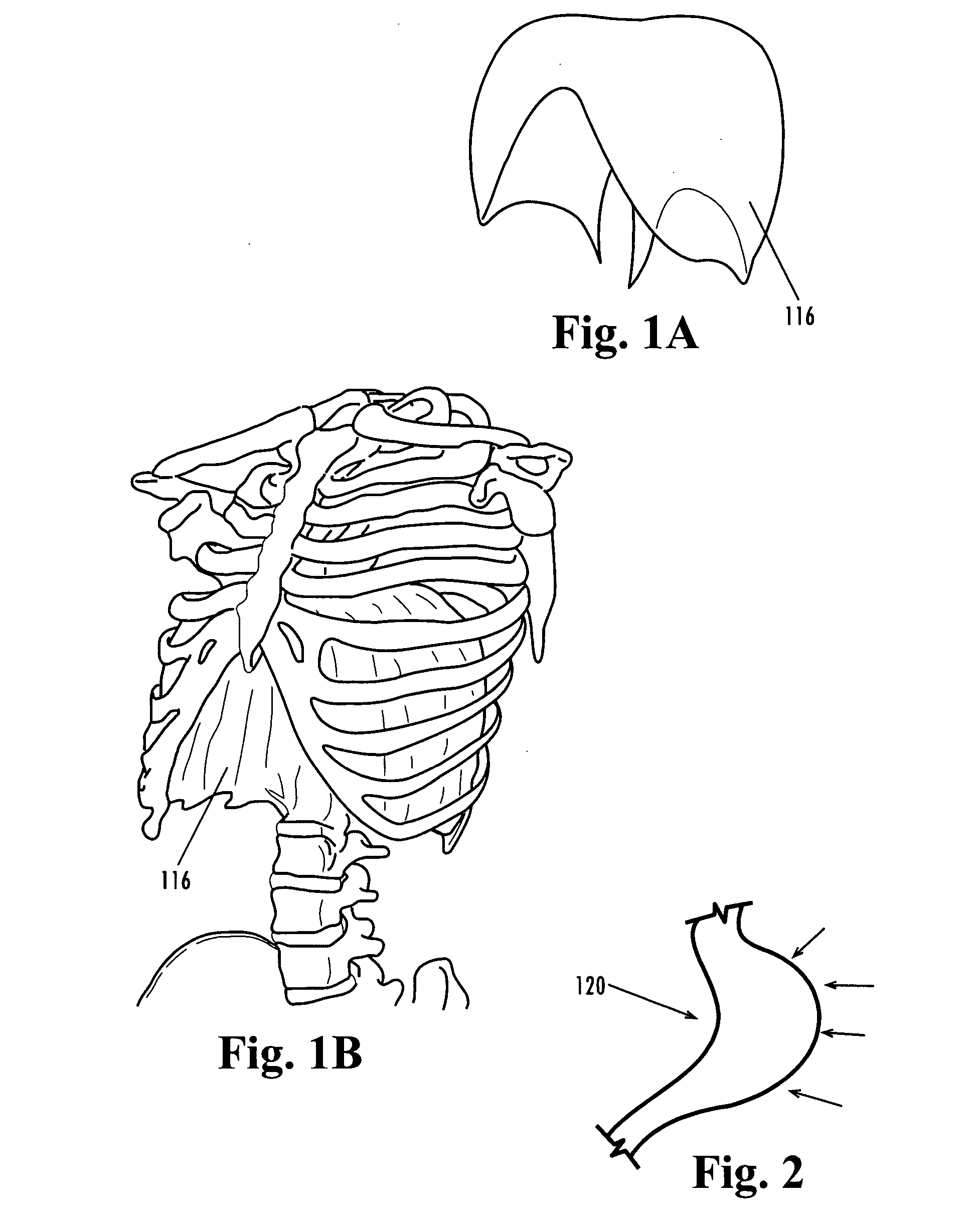 Devices and methods for treatment of obesity