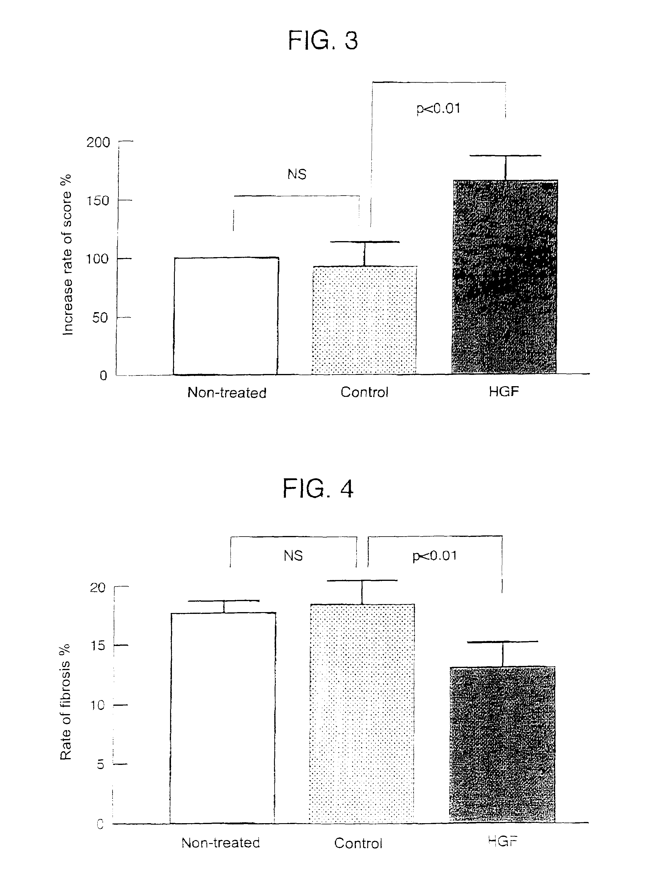 Gene therapy for cardiomyopathy