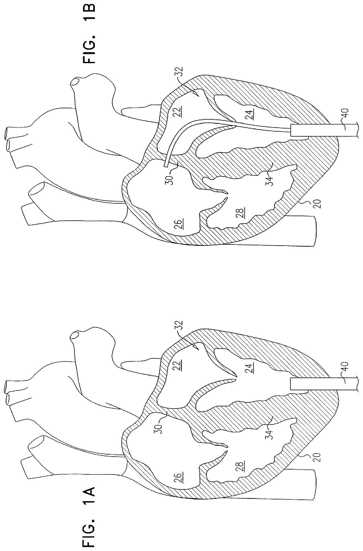 Techniques for providing a replacement valve and transseptal communication