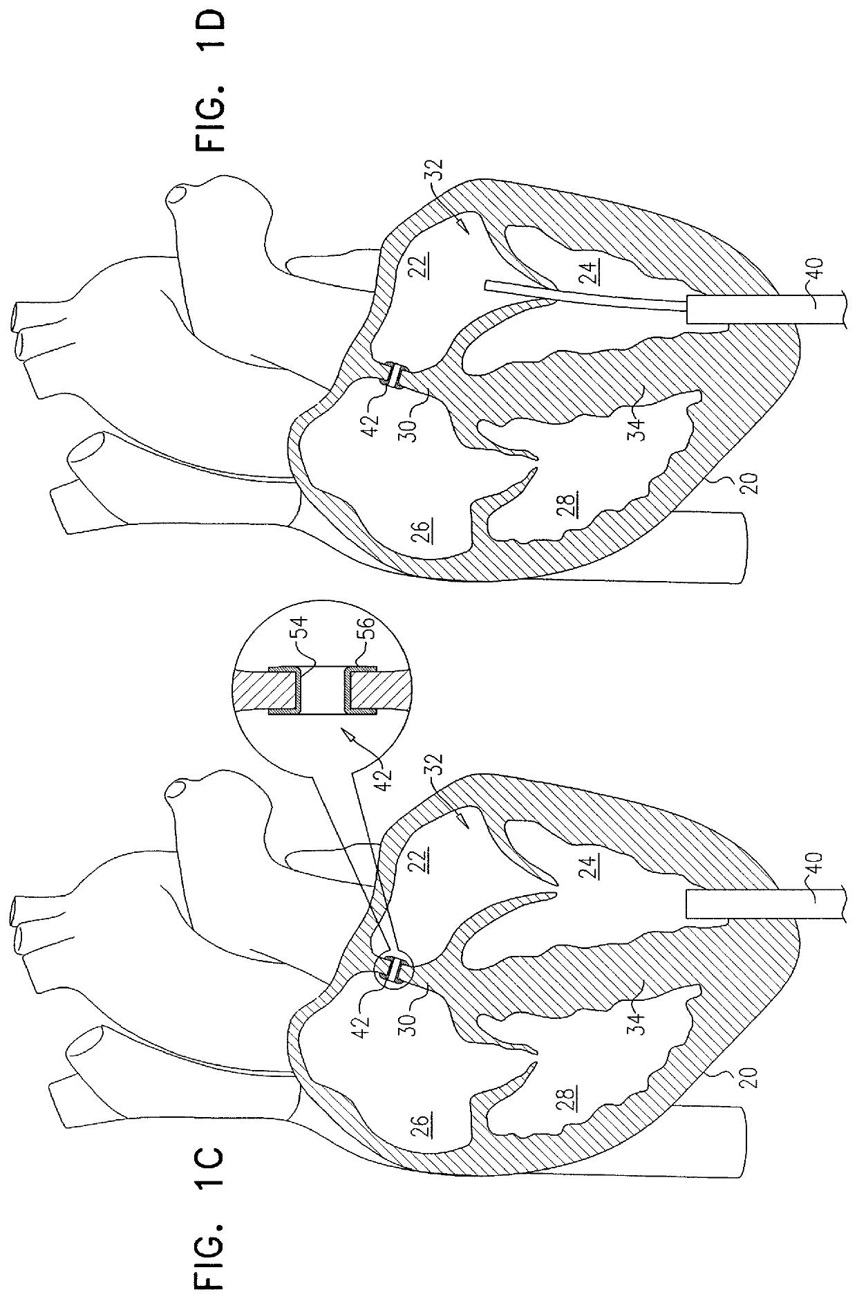 Techniques for providing a replacement valve and transseptal communication